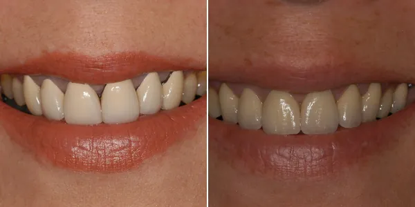 Smile Makeover (multiple procedures) before and after — St. George Center for Specialized Dentistry, St. George, UT