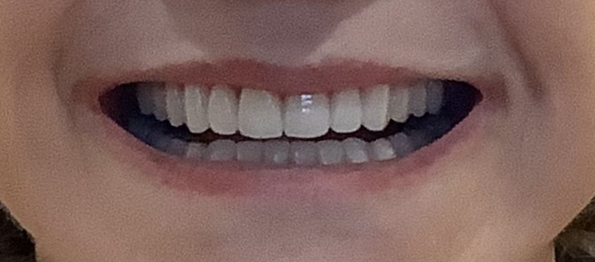 After treatment