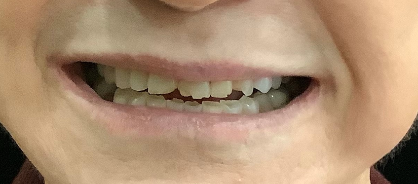 Before treatment