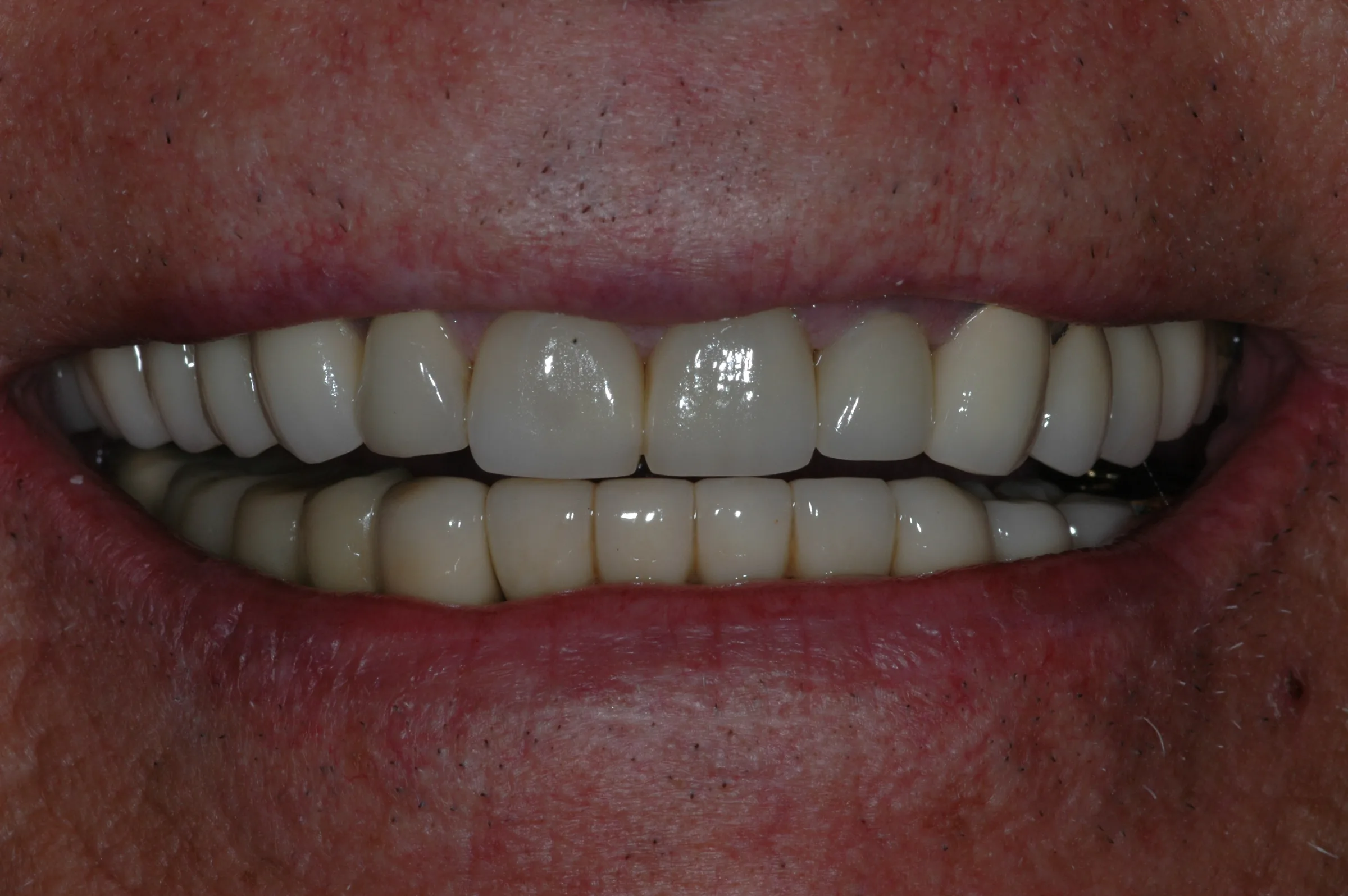 After — Full Mouth Reconstruction