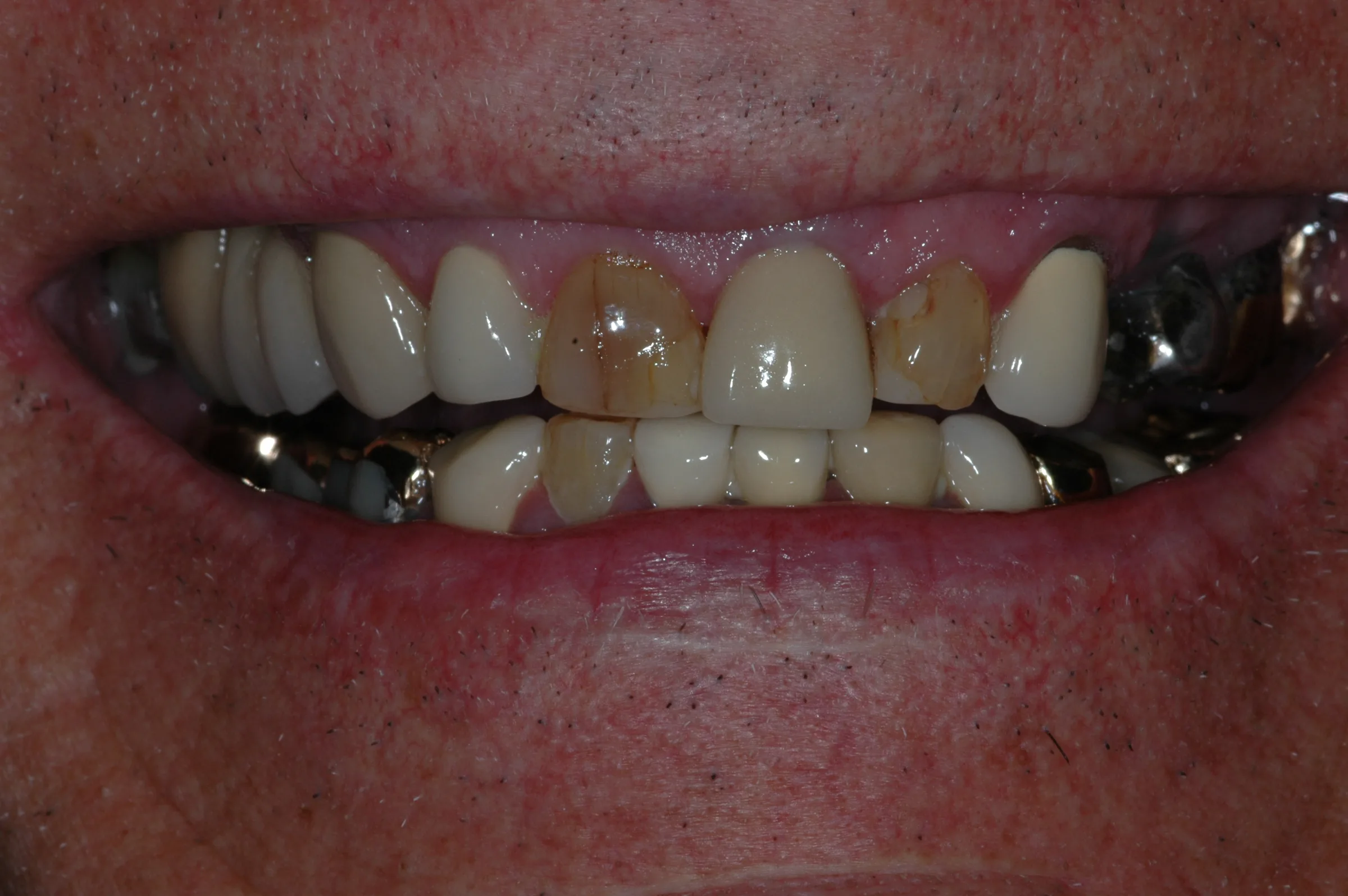 Before — Full Mouth Reconstruction