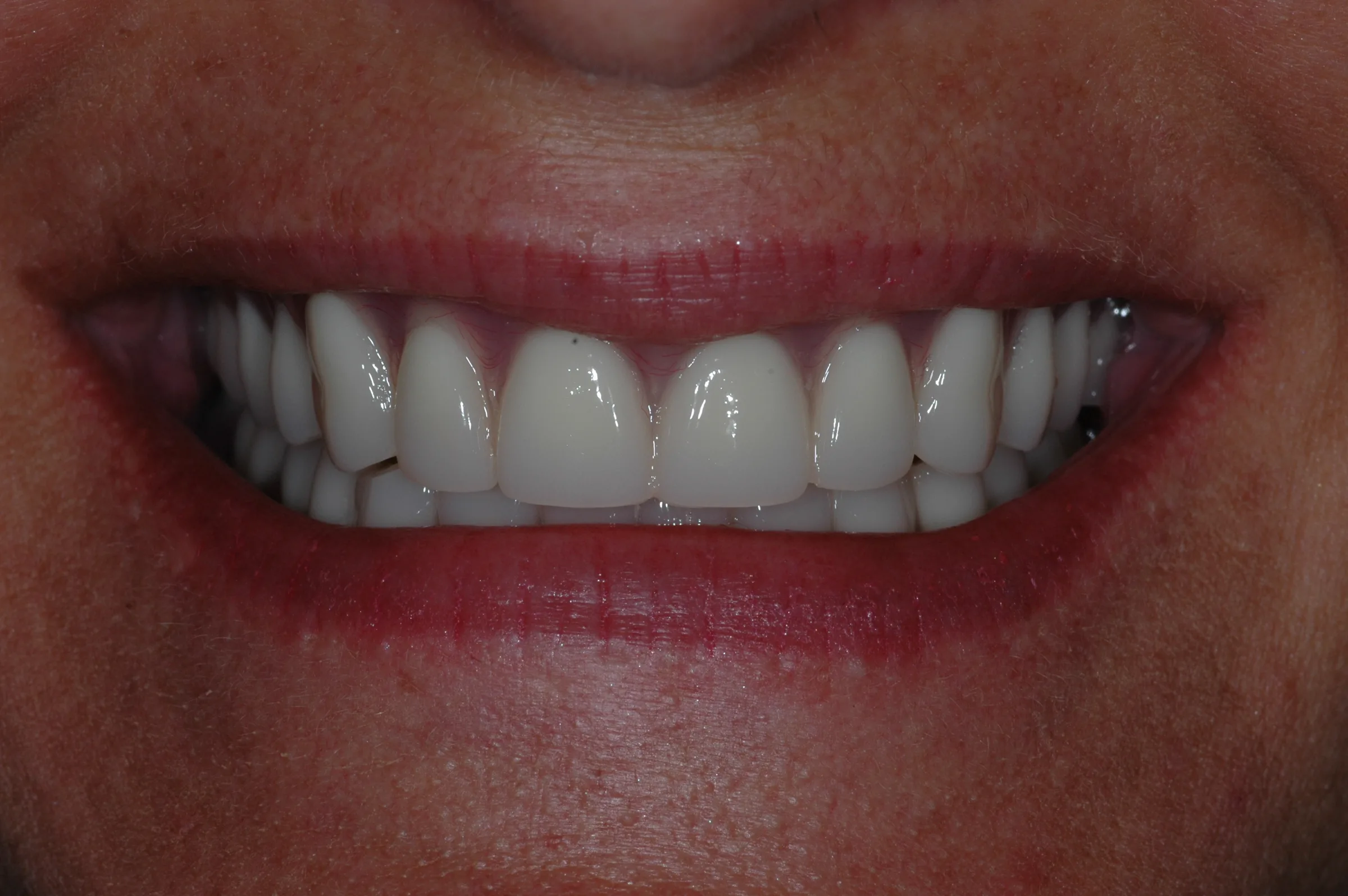 After — Dentures