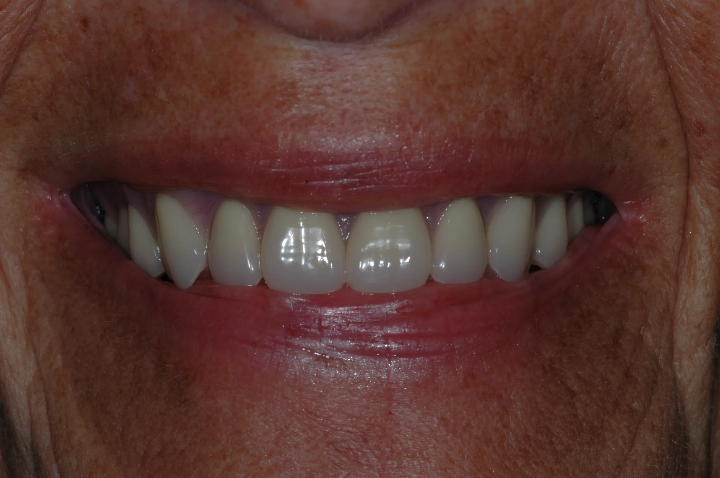 After — Replacement Dentures