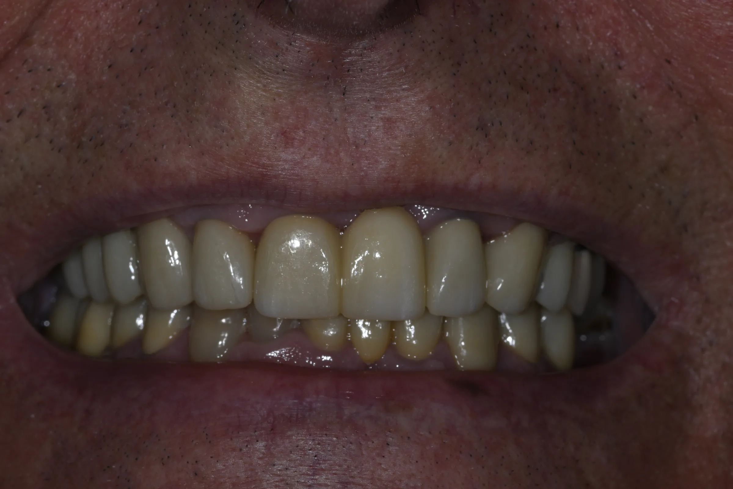 After — Full Mouth Reconstruction