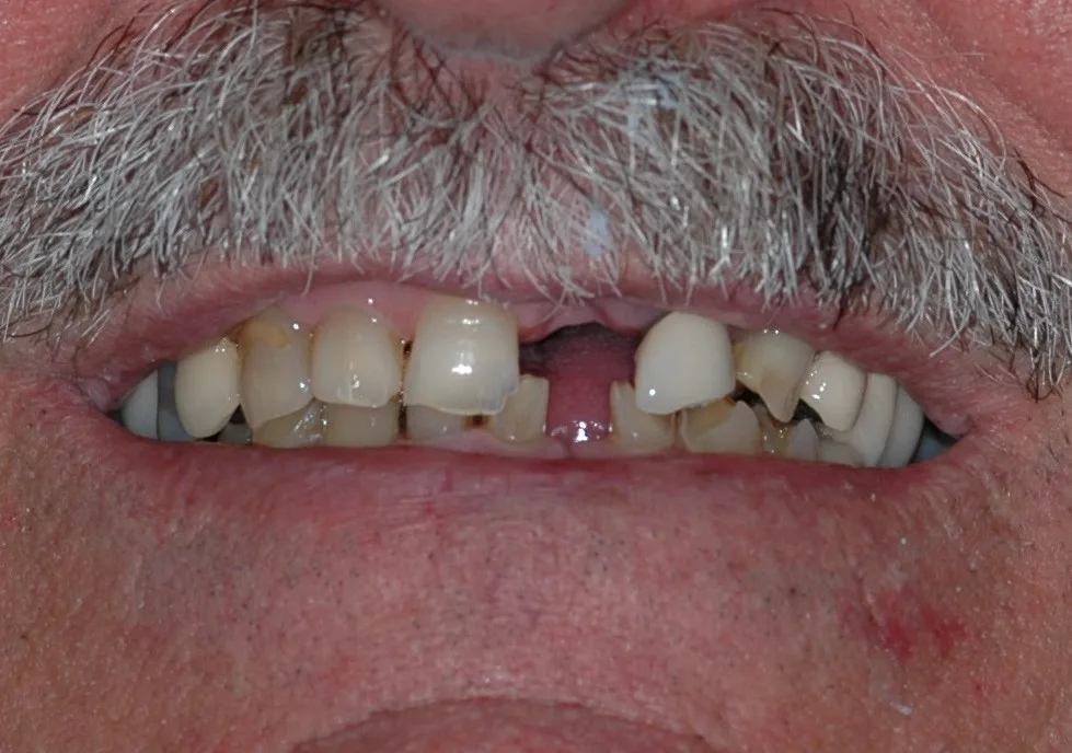 Before — Full Mouth Reconstruction