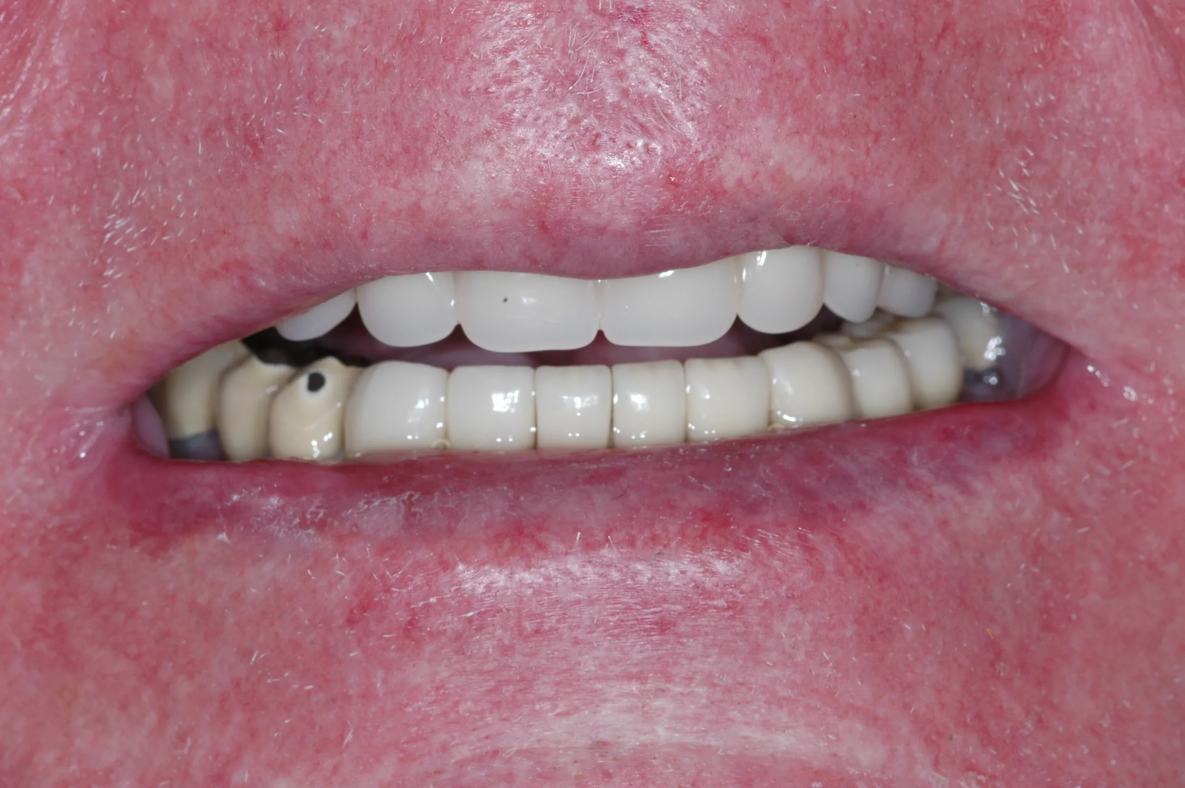 After — Full Mouth Reconstruction