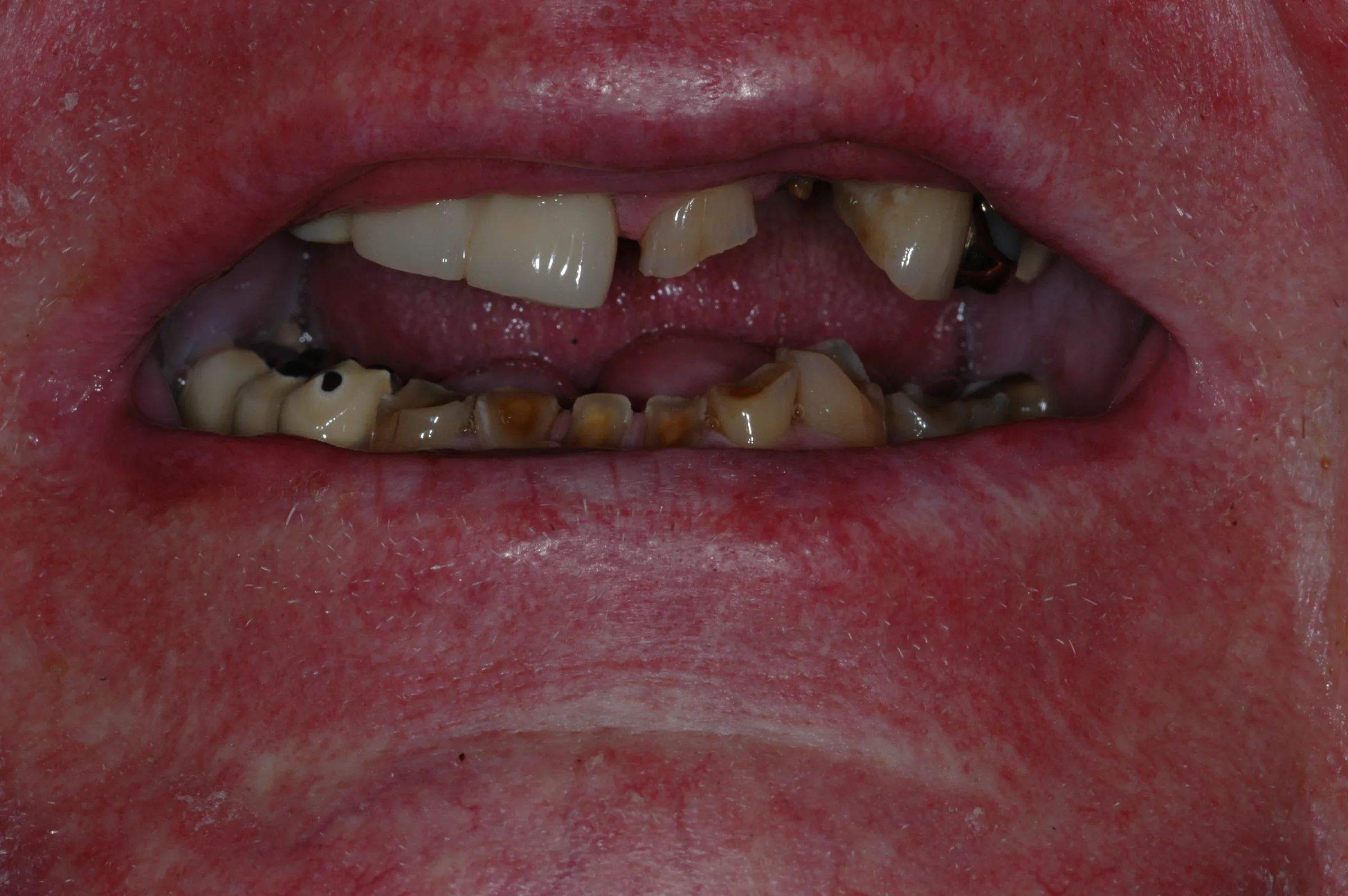 Before — Full Mouth Reconstruction