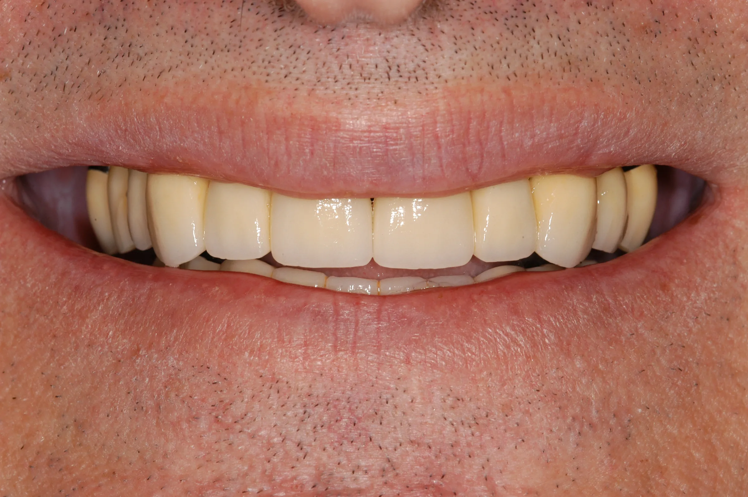 After — Crowns