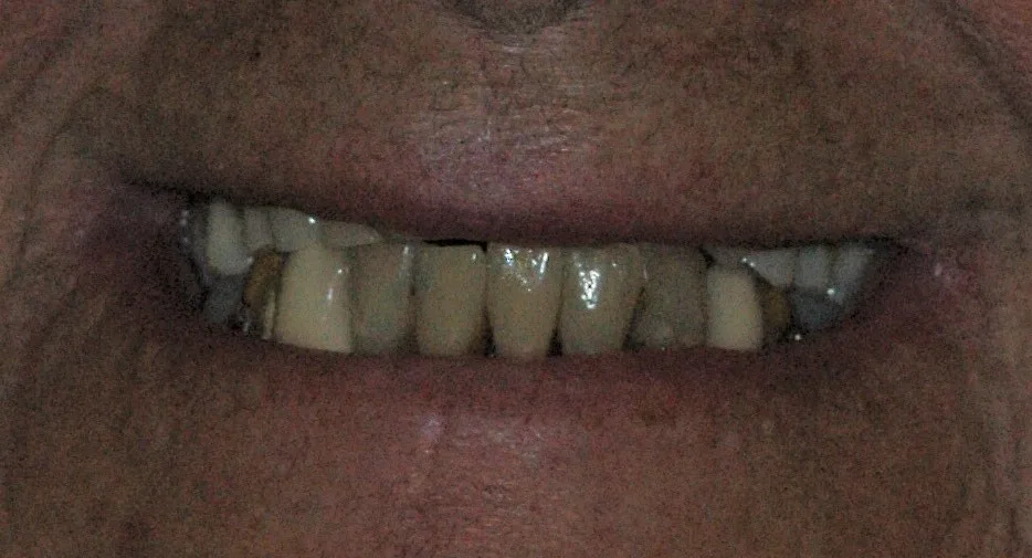 Before — Full Mouth Reconstruction
