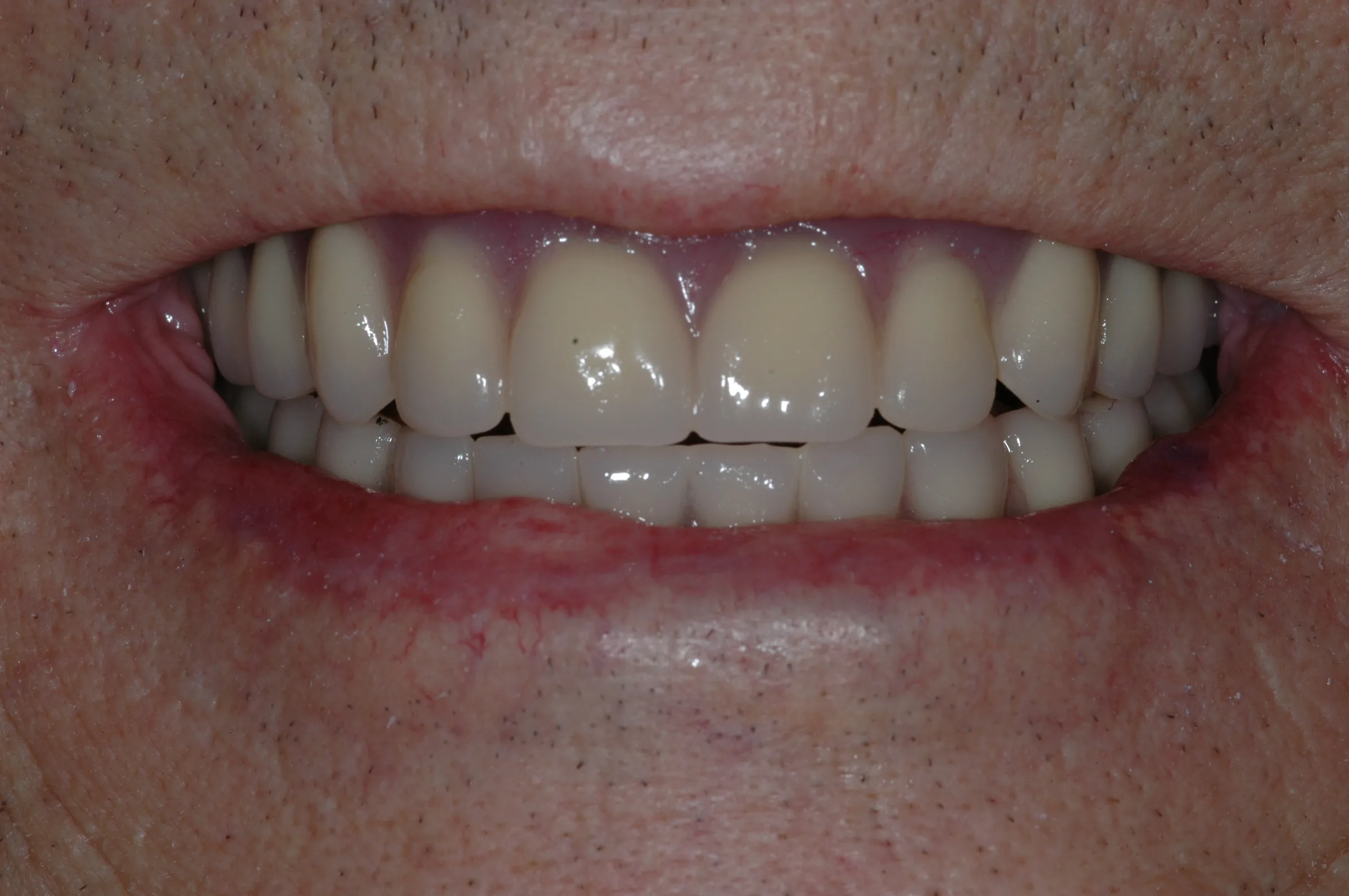 After — All-on-4 / Full Arch