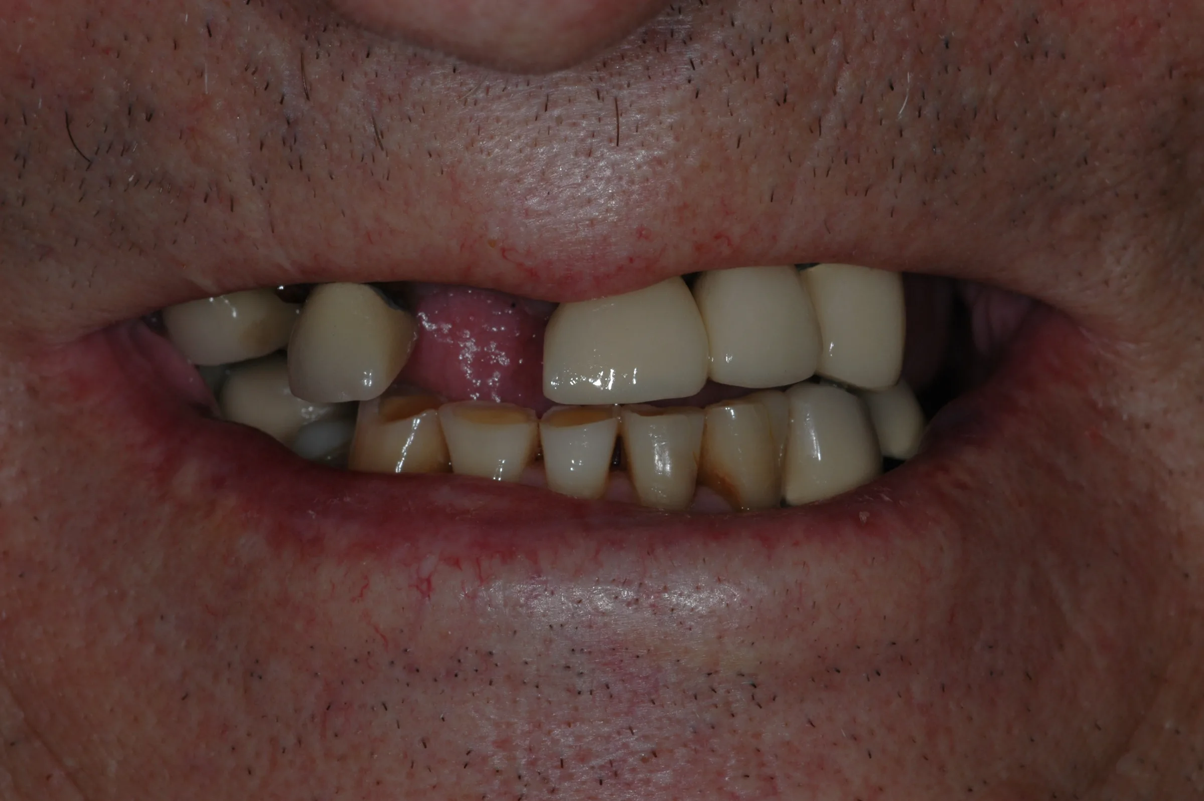 Before — All-on-4 / Full Arch