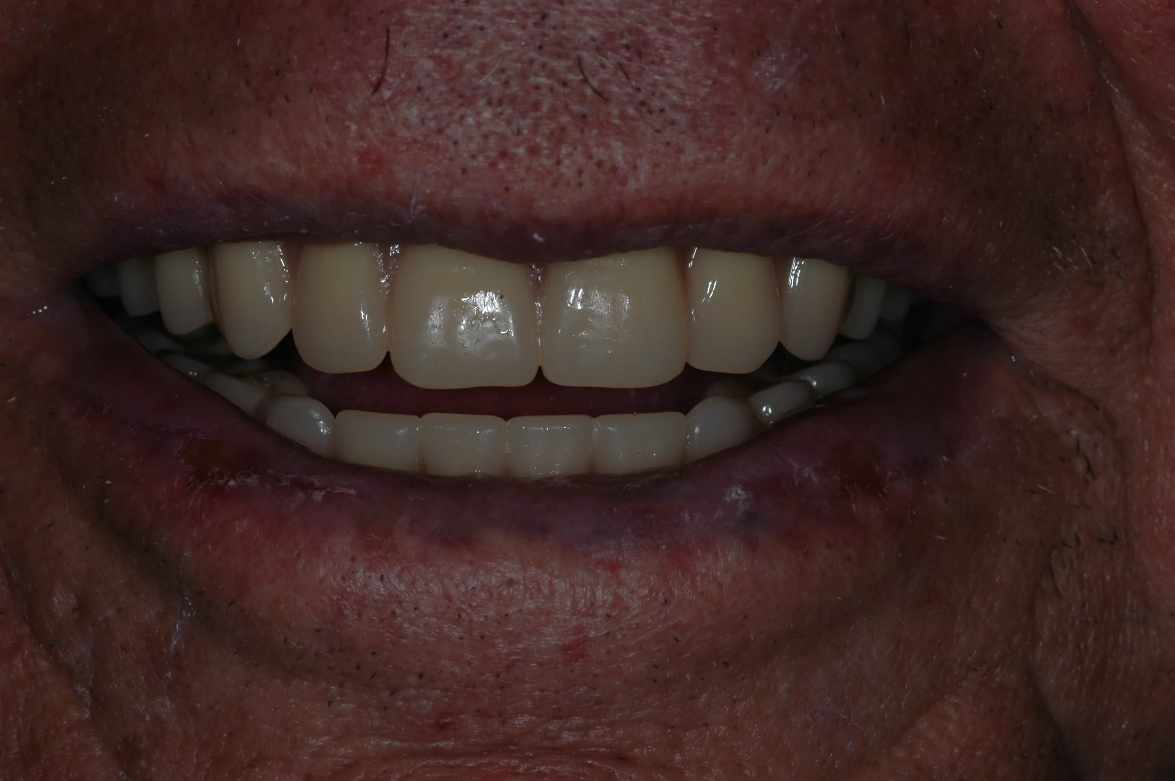 After — Complete Dentures