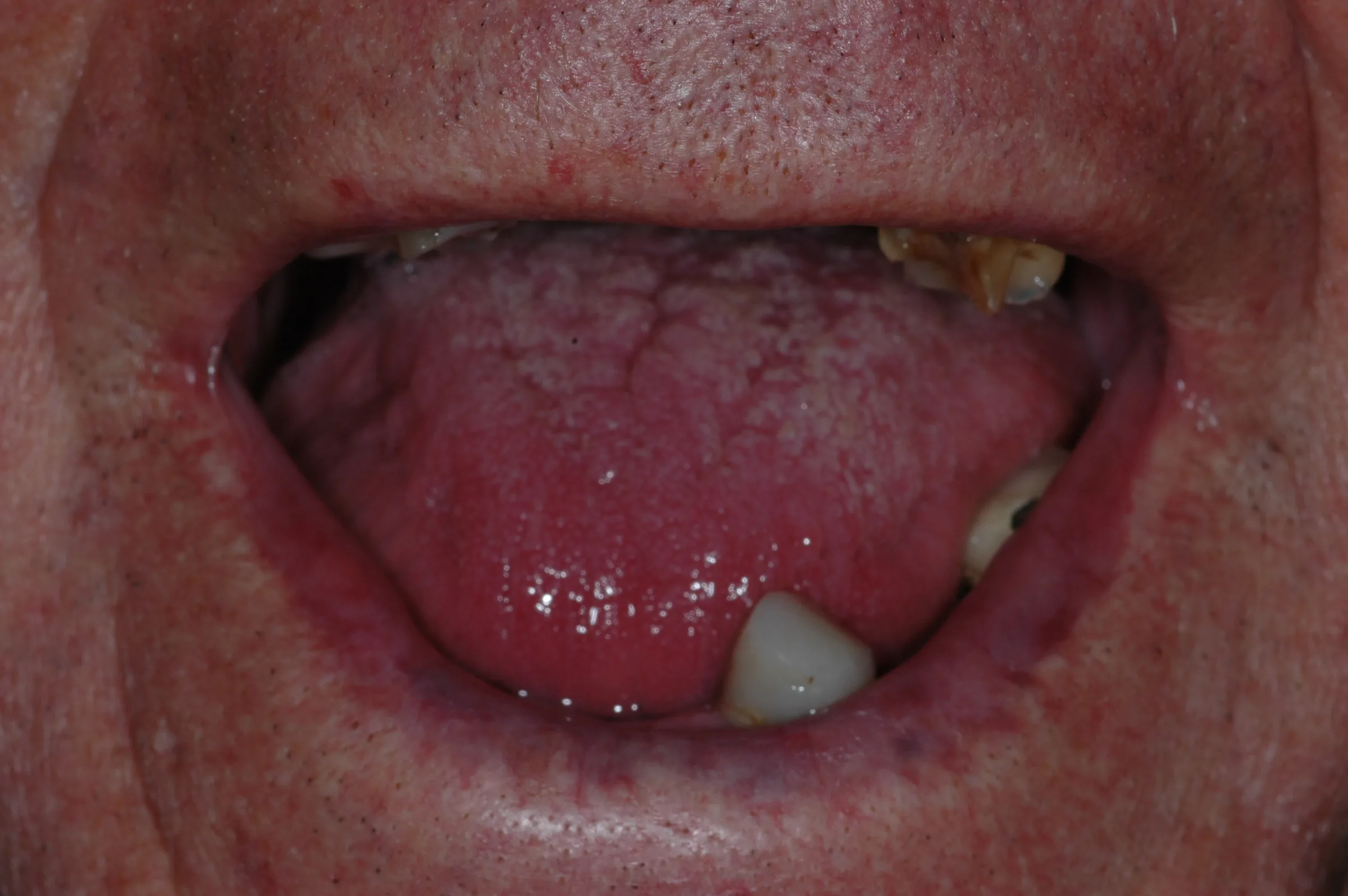 Before — Complete Dentures