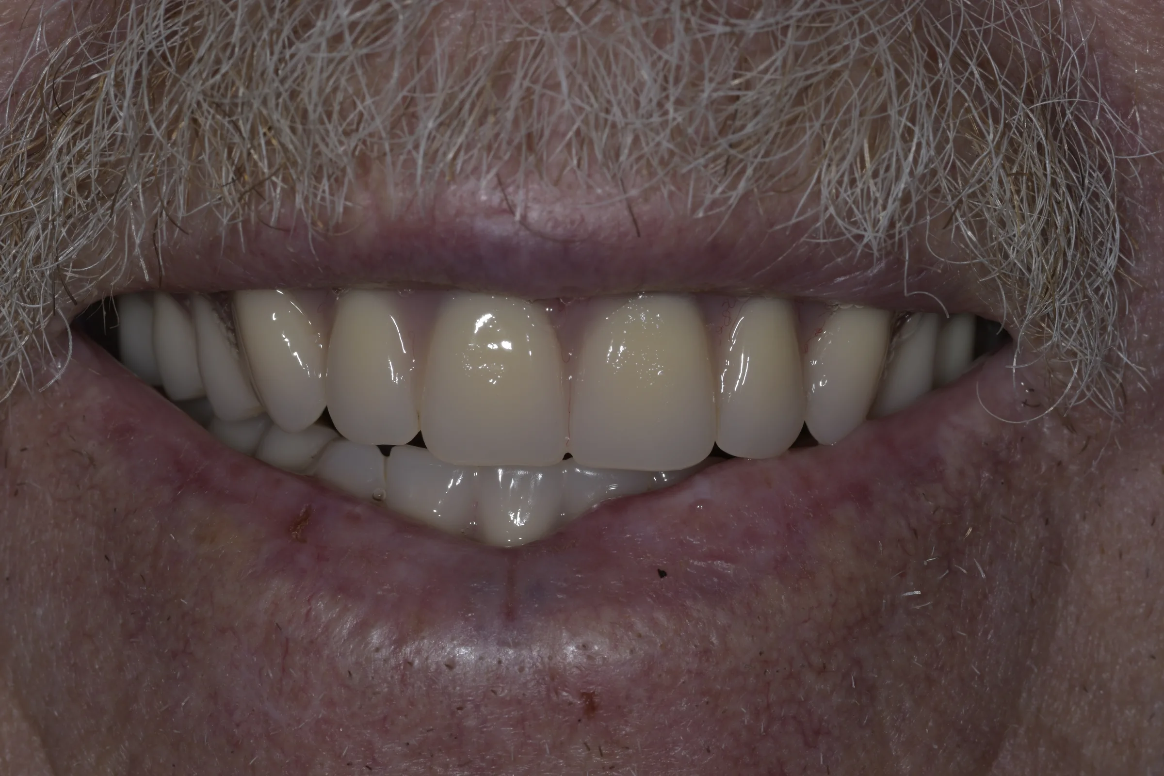 After — Dentures