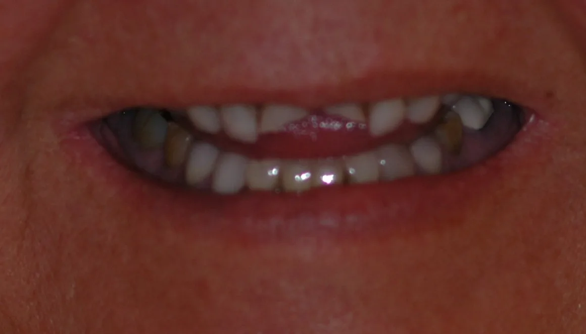 Before — Full Mouth Reconstruction