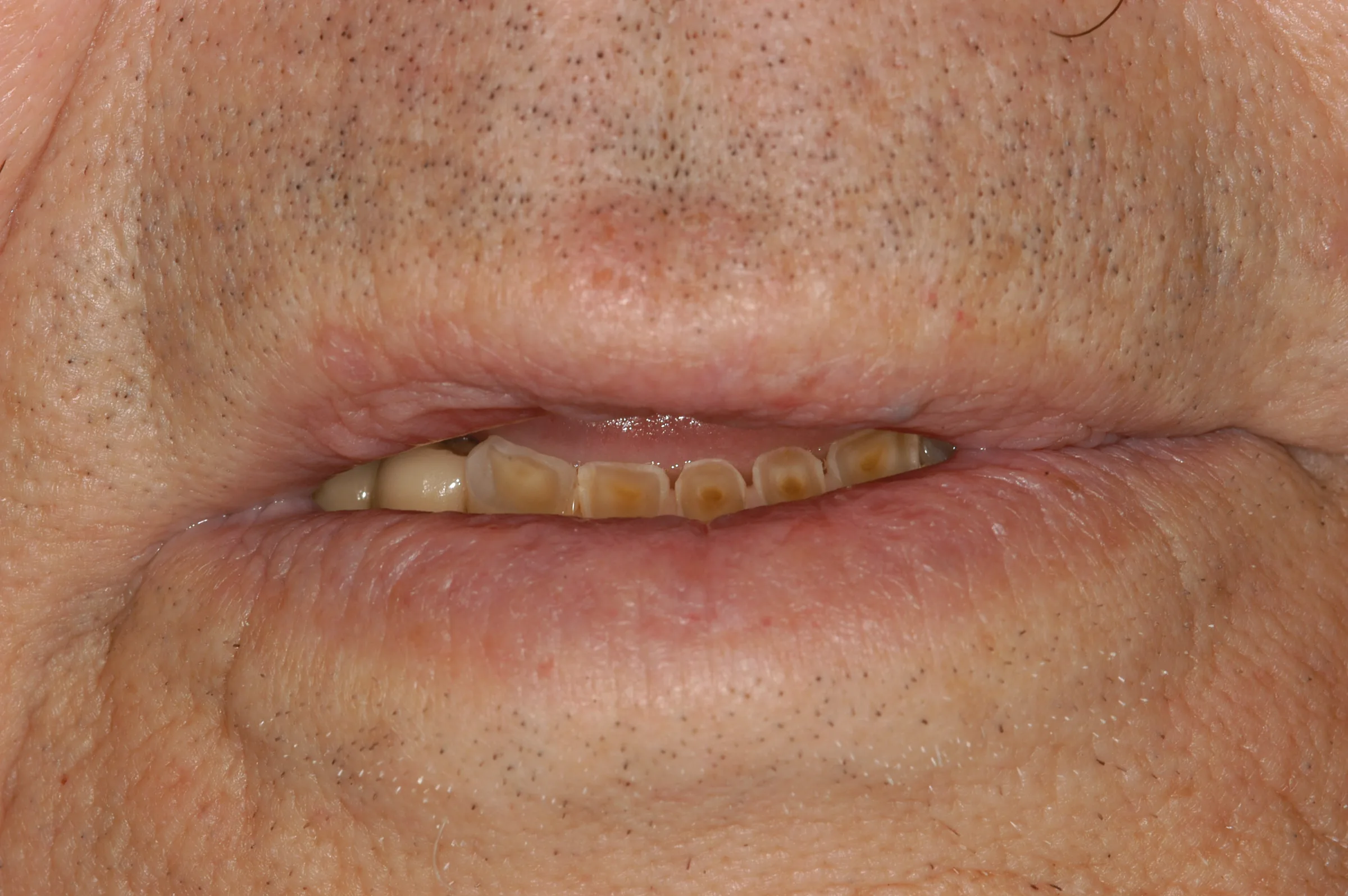 Before — Full Mouth Reconstruction