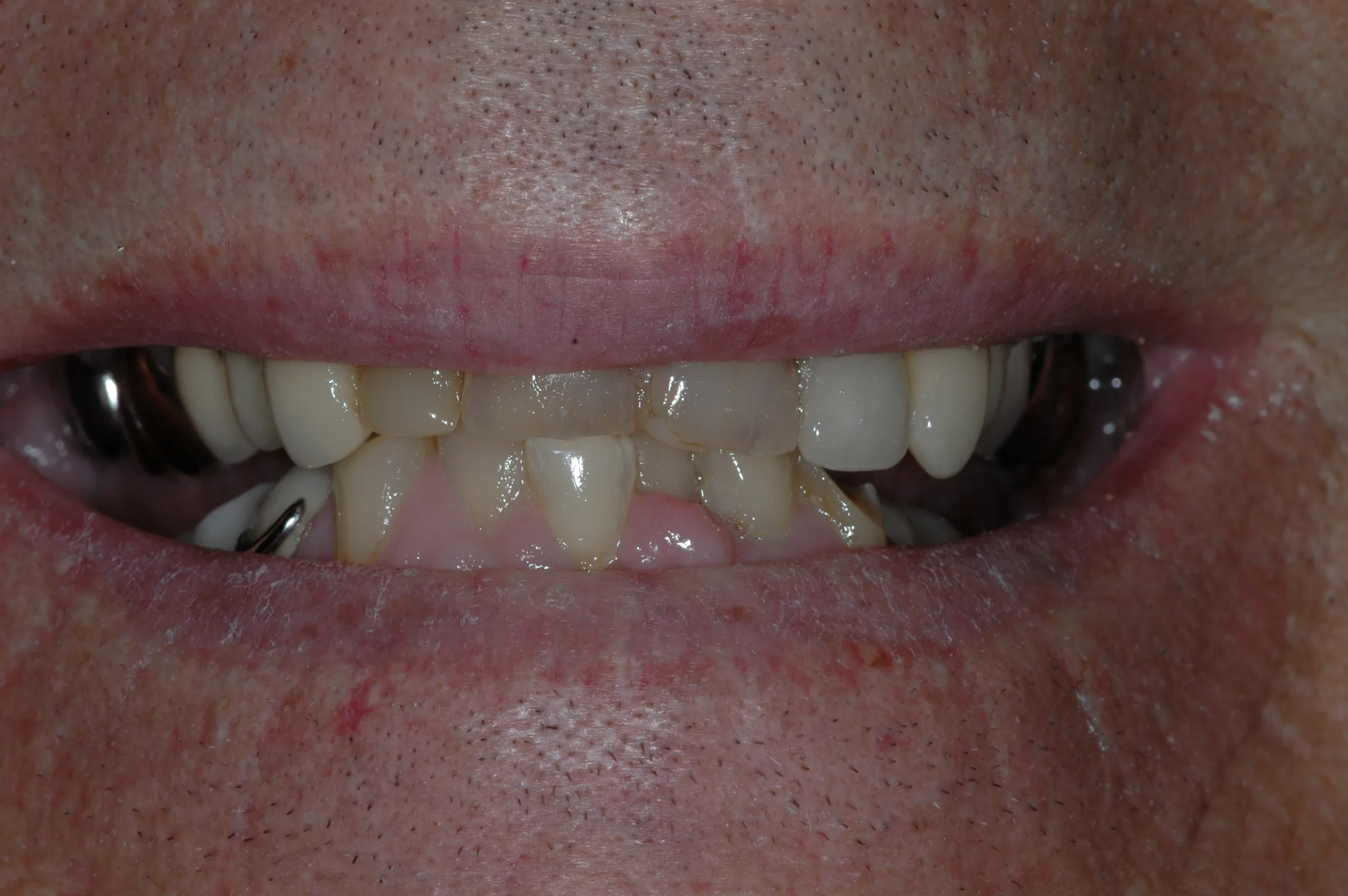 Before — Full Mouth Reconstruction