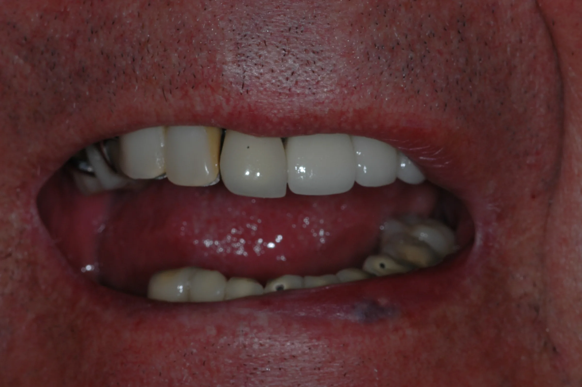 Before — Full Mouth Reconstruction