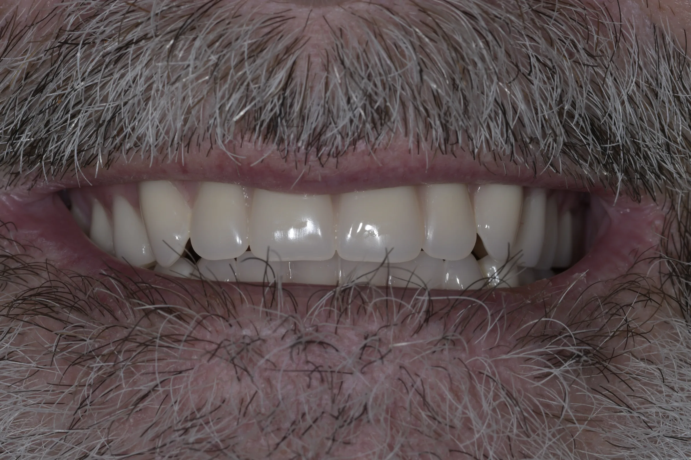 After — Snap-On Denture