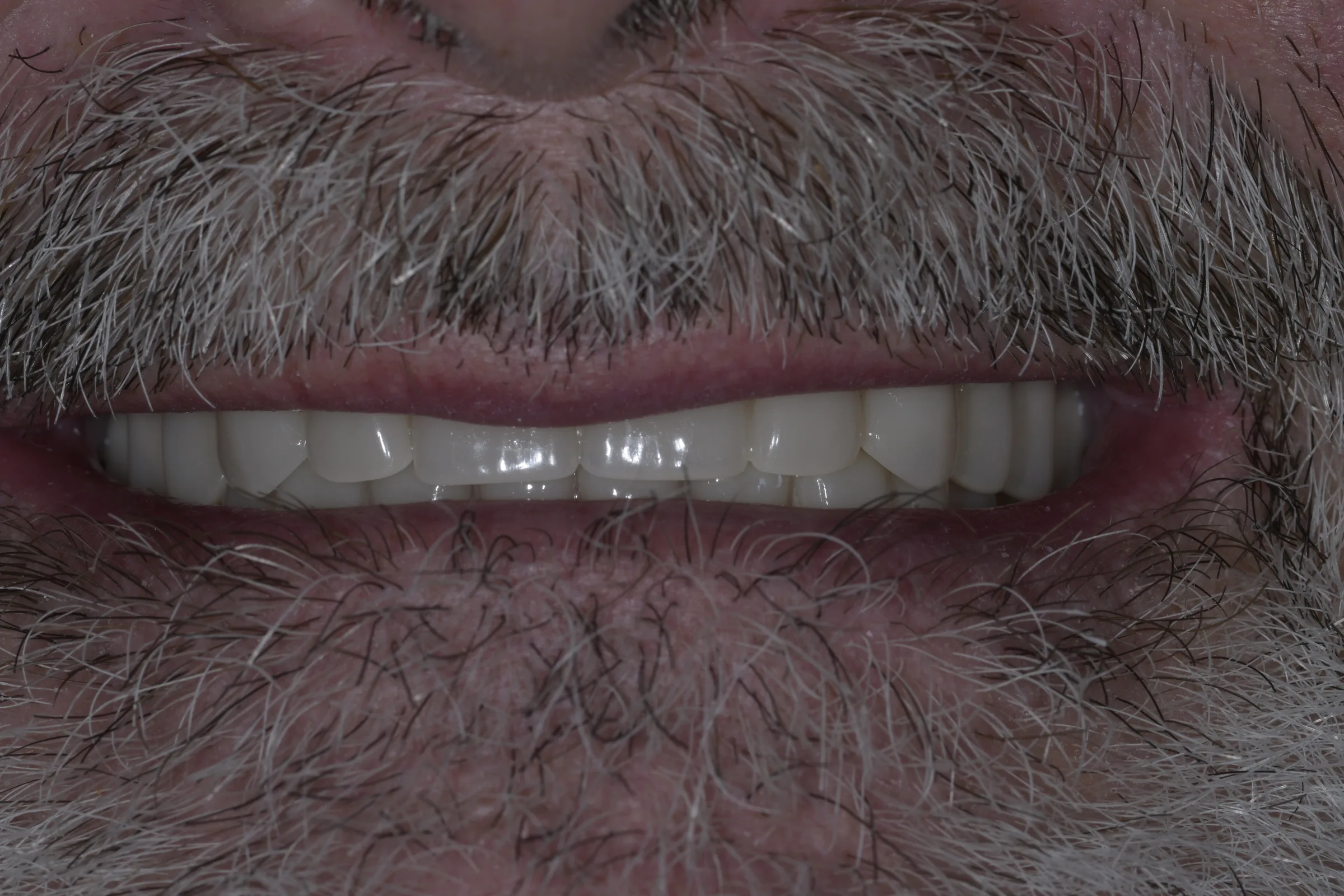 Before — Snap-On Denture