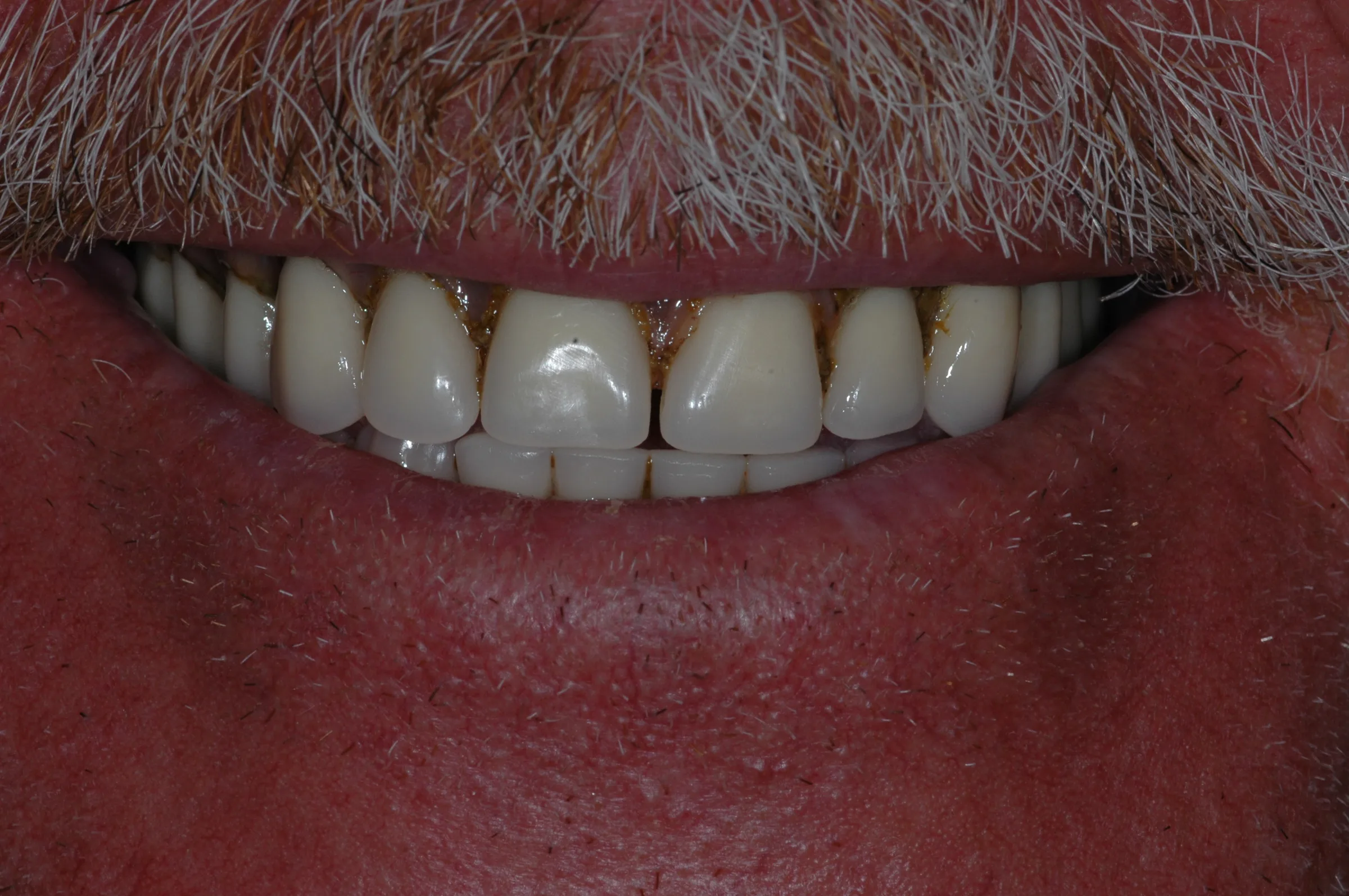 Before — Snap-On Denture