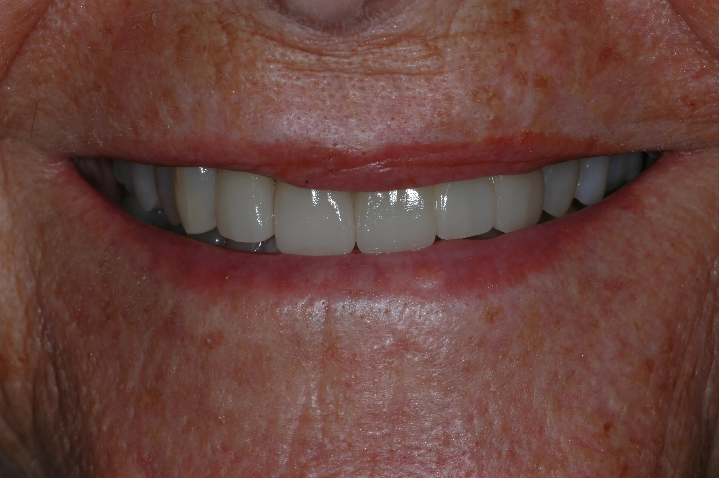 After — Full Mouth Reconstruction