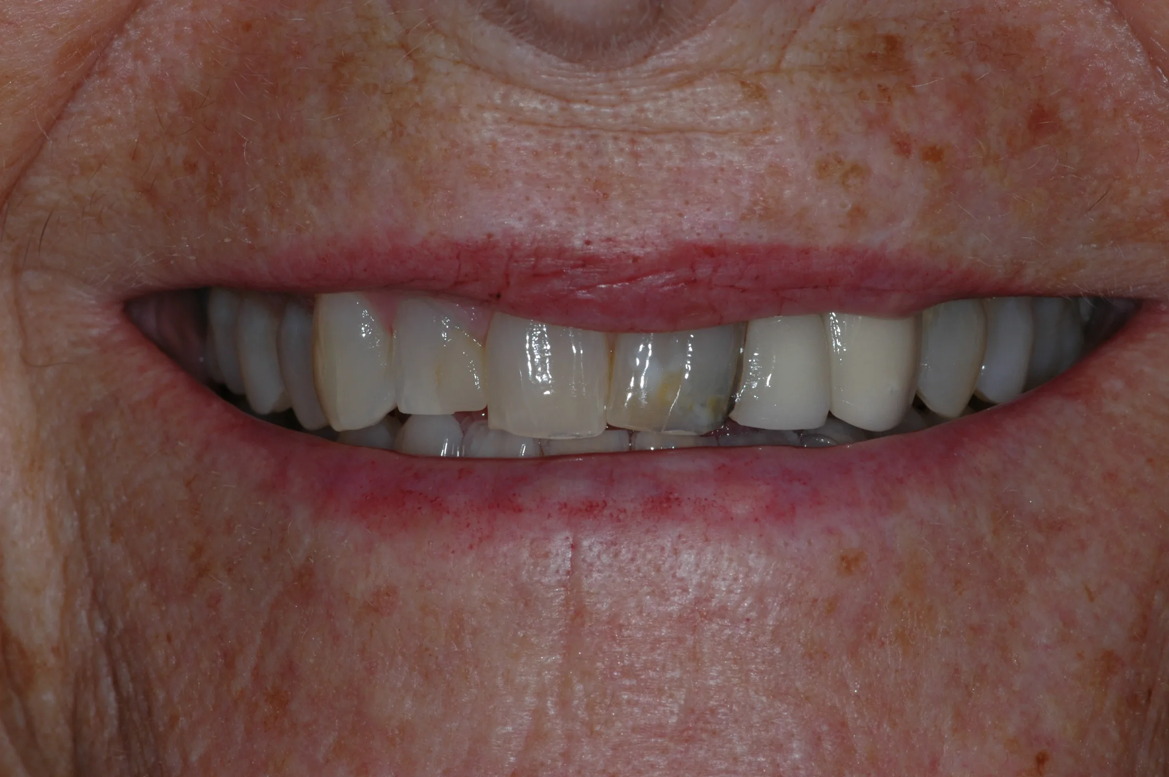 Before — Full Mouth Reconstruction