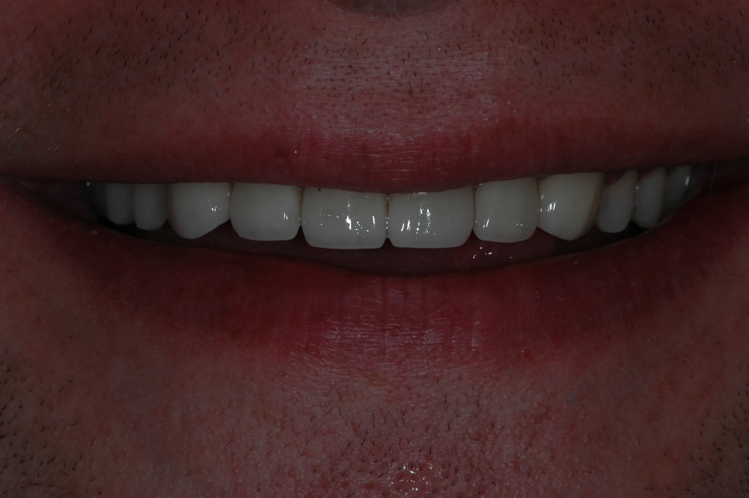 After — Crowns