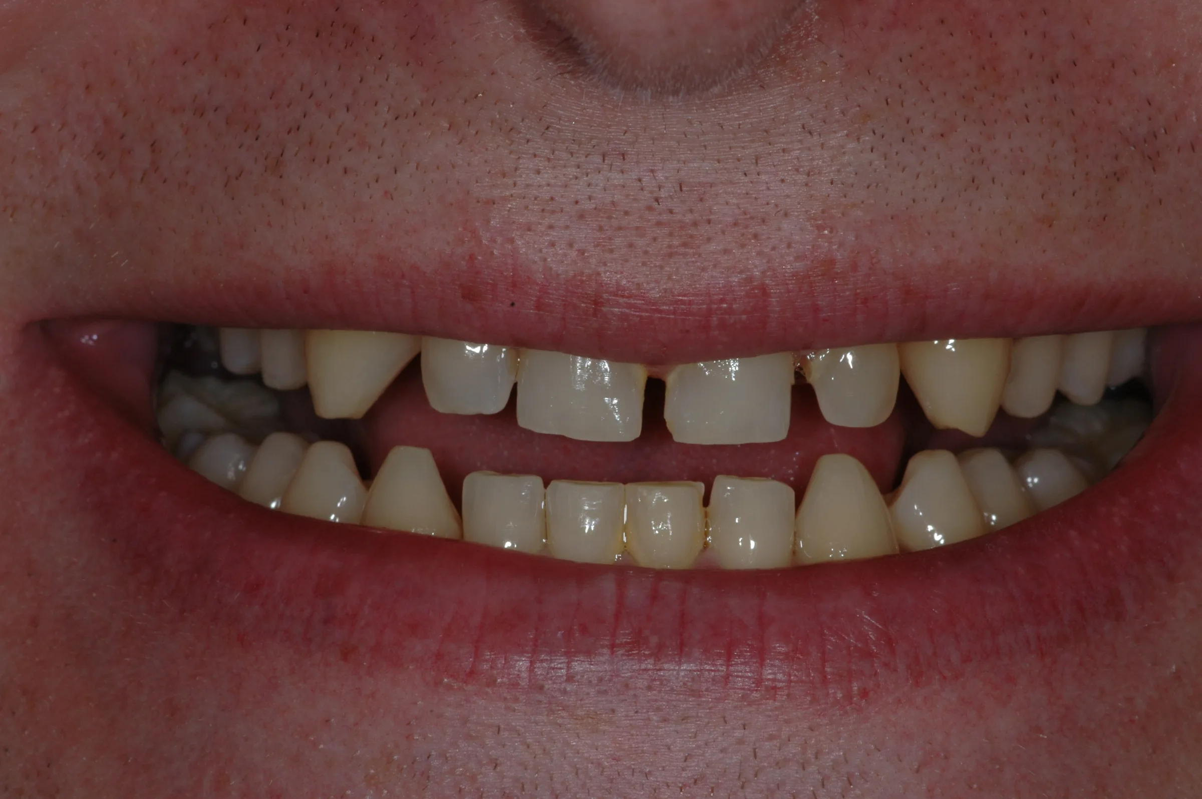 Before — Crowns