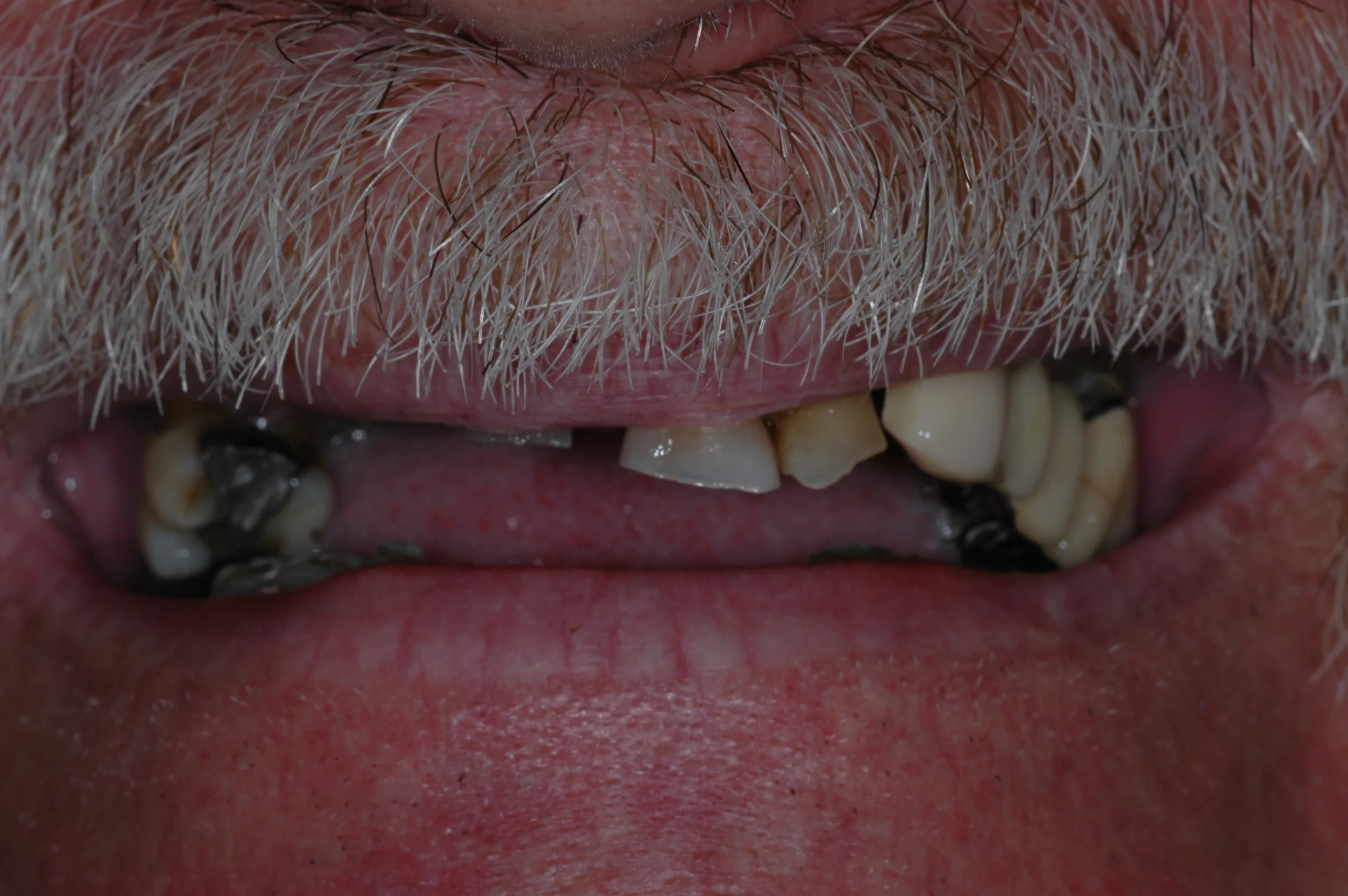 Before — Dentures