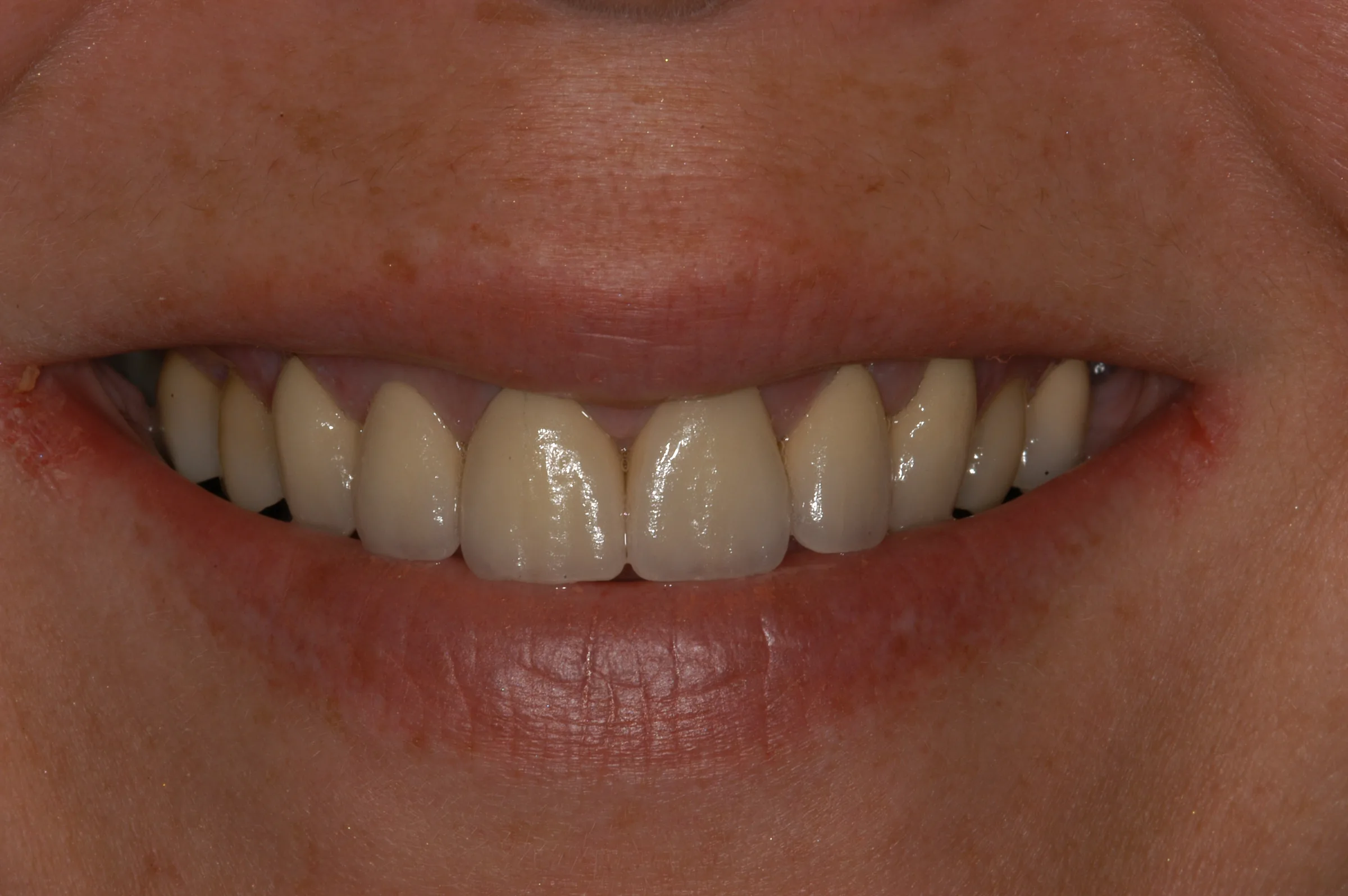 After — Smile Makeover