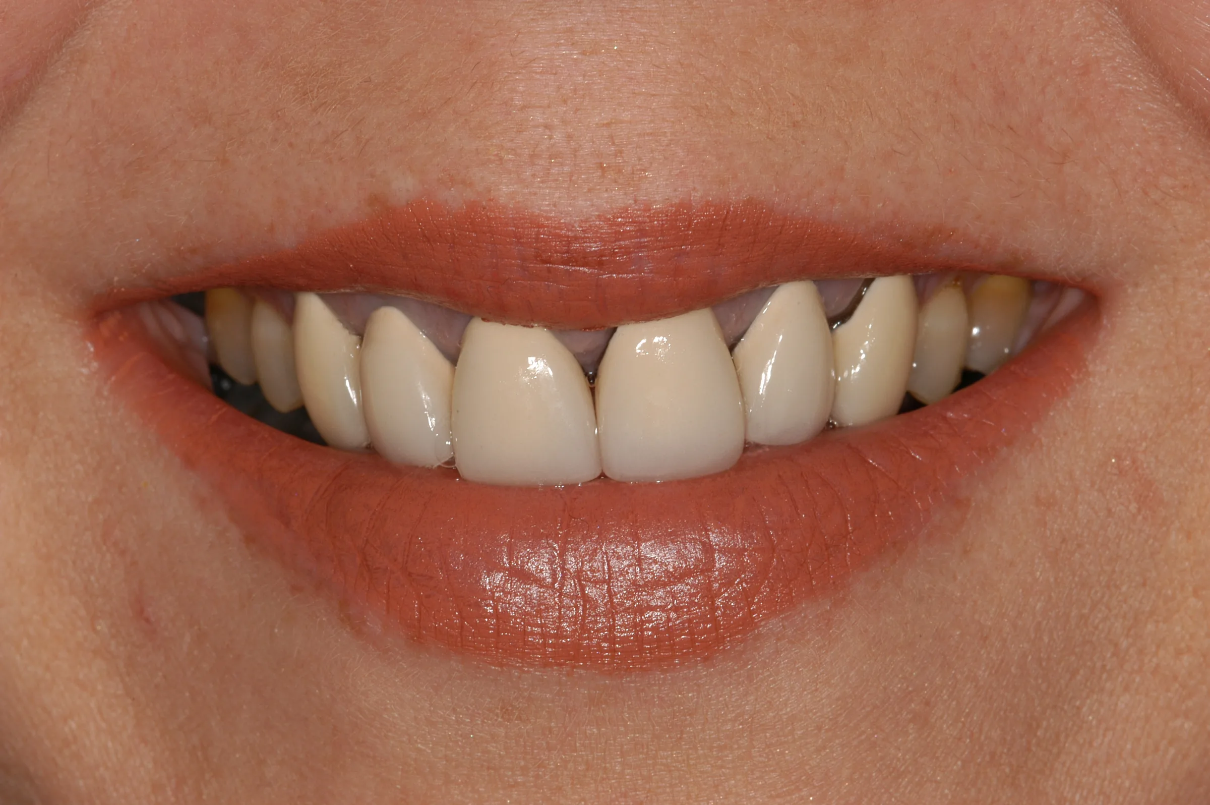 Before — Smile Makeover