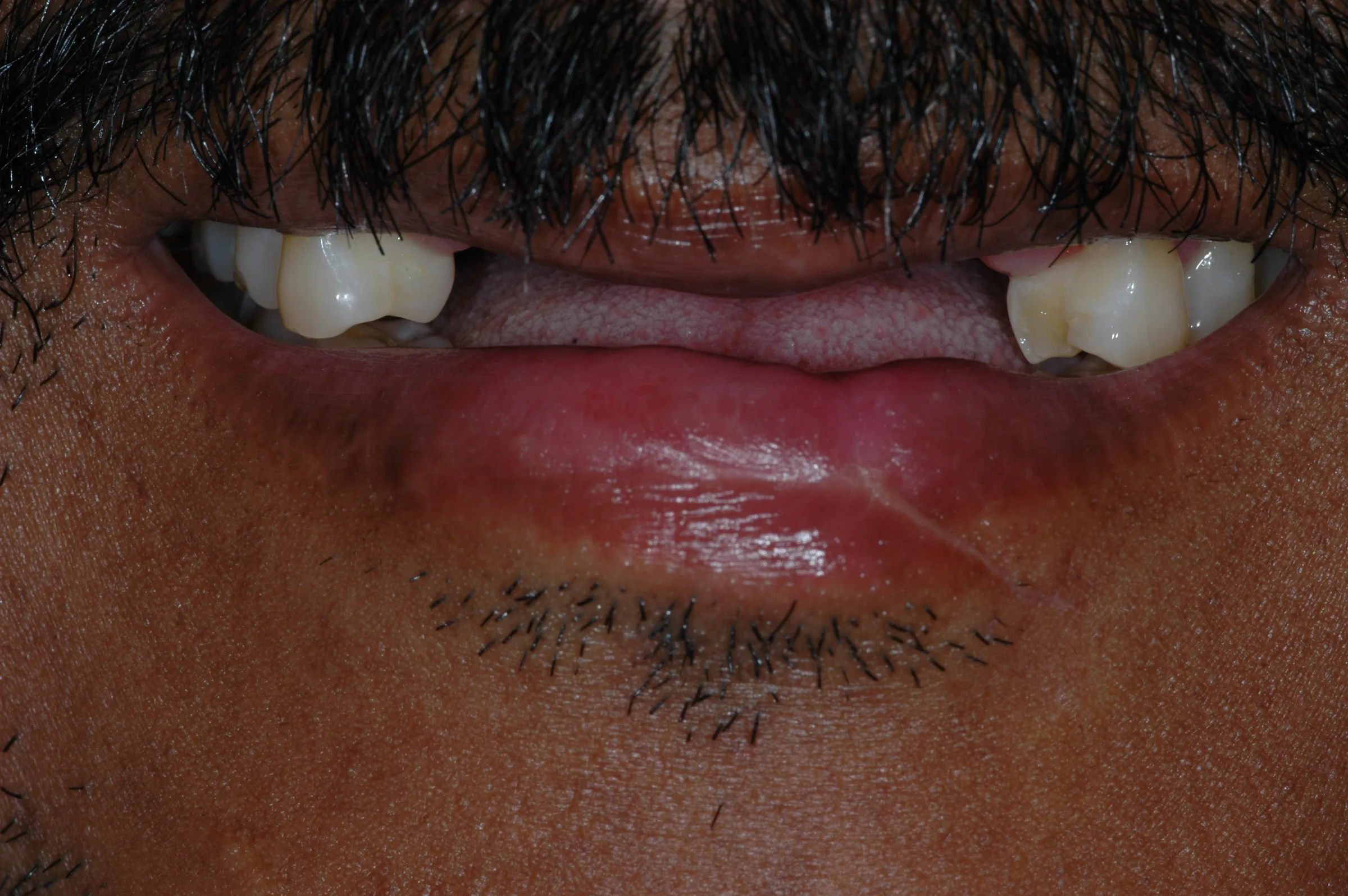 Before — Fixed Implant Prosthesis