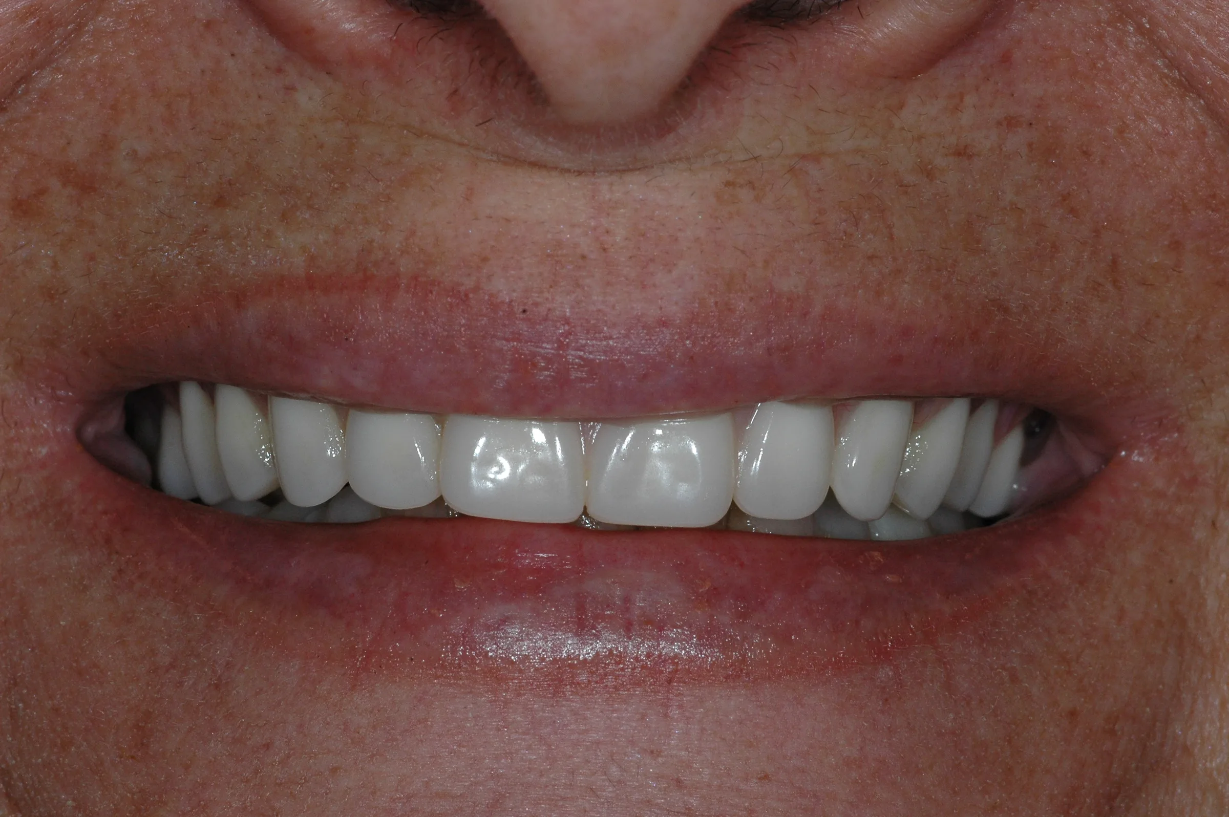 After — Dentures