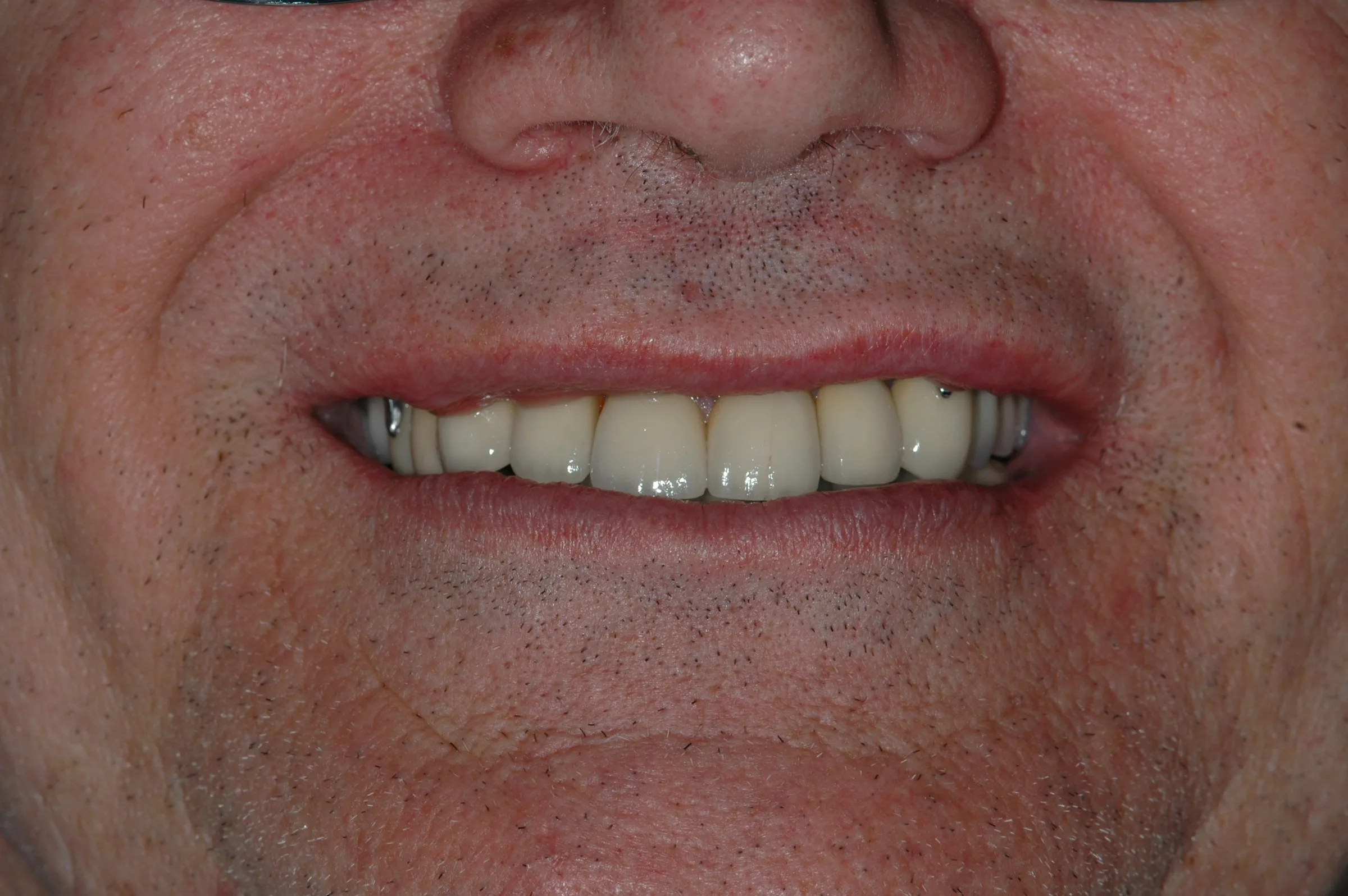 After — Full Mouth Reconstruction