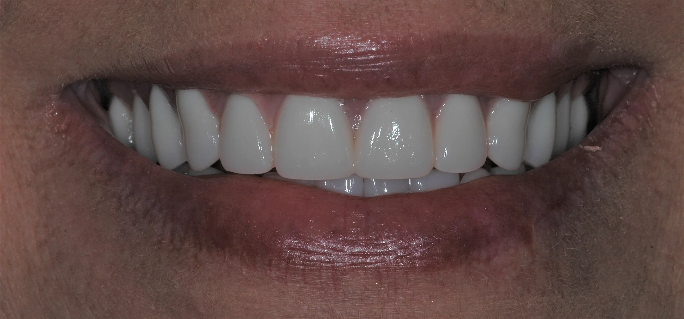 After — Dentures