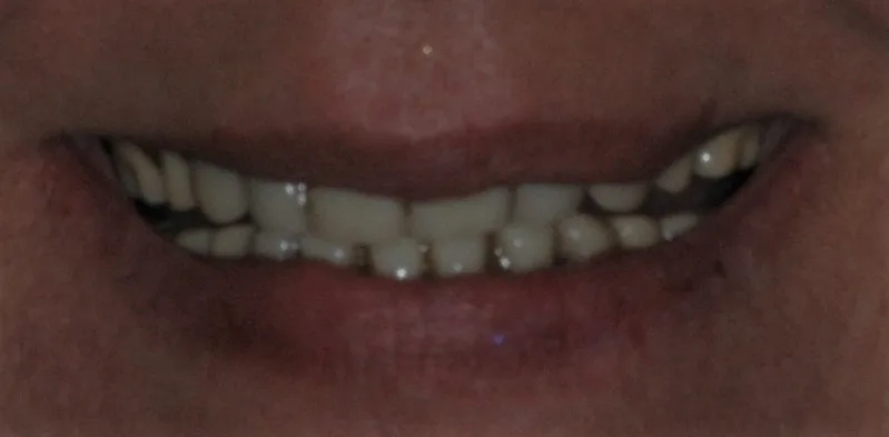 Before — Dentures