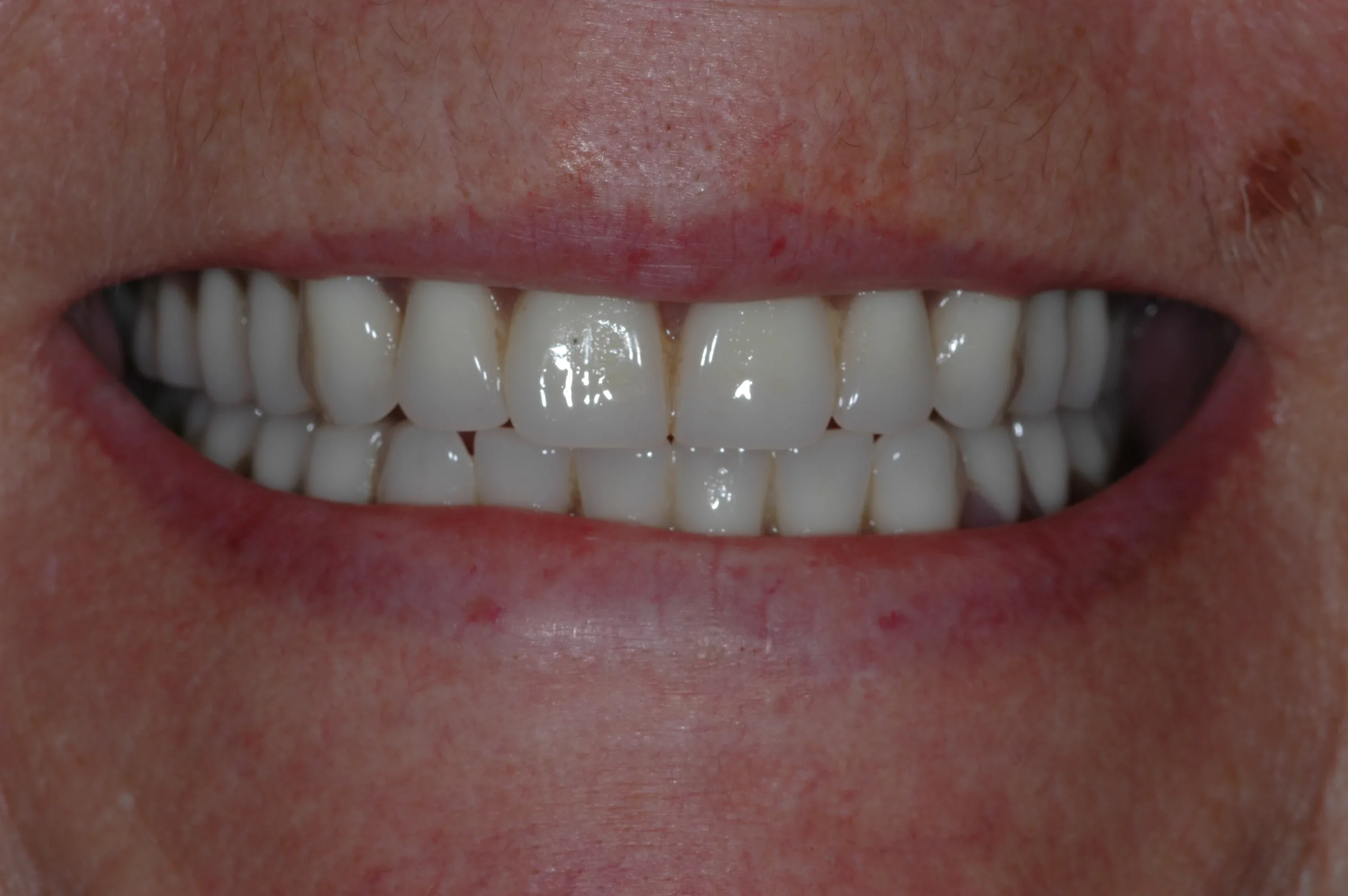 After — Dentures