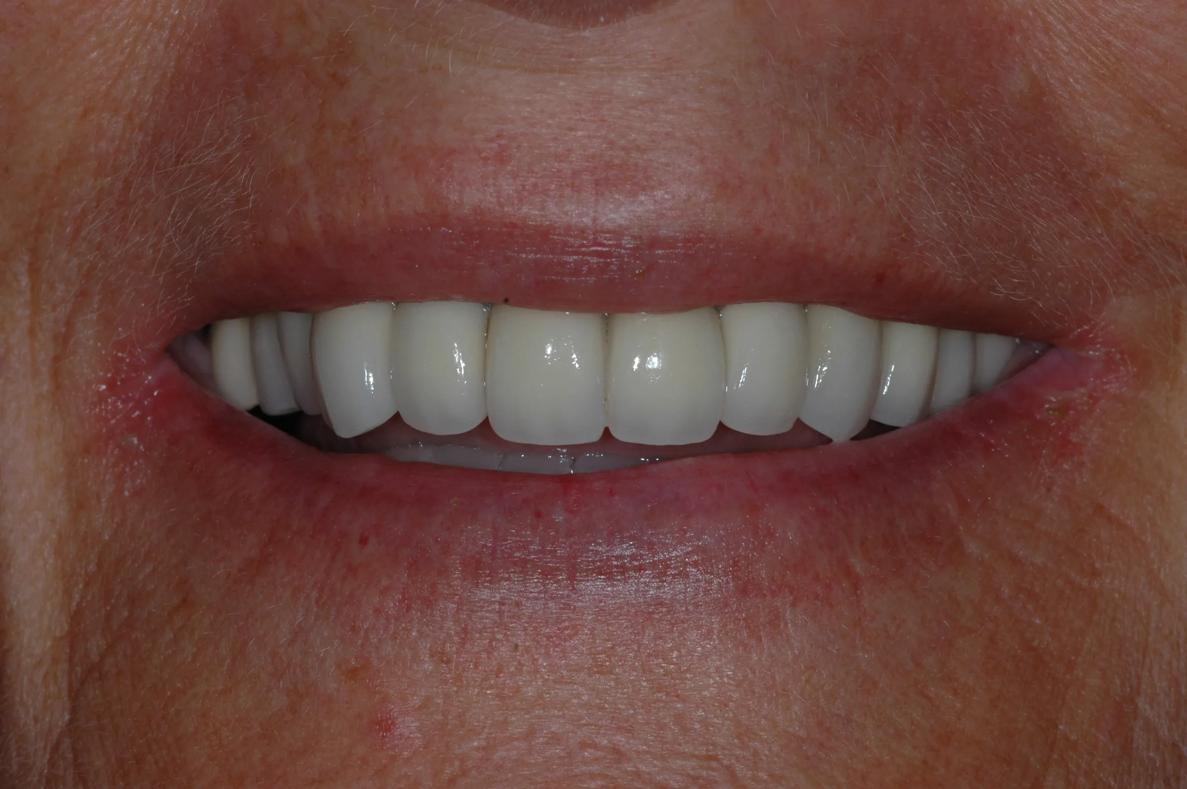 After — Full Mouth Reconstruction