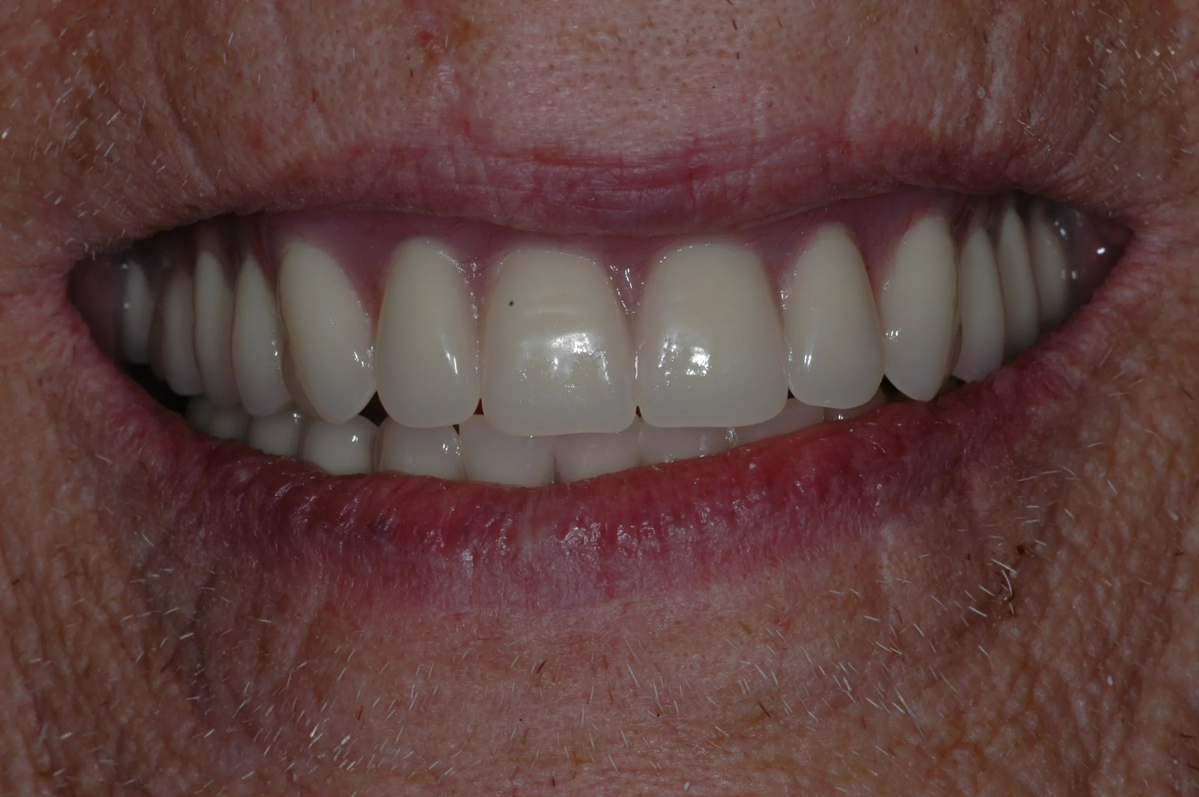 After — All-on-4 / Full Arch