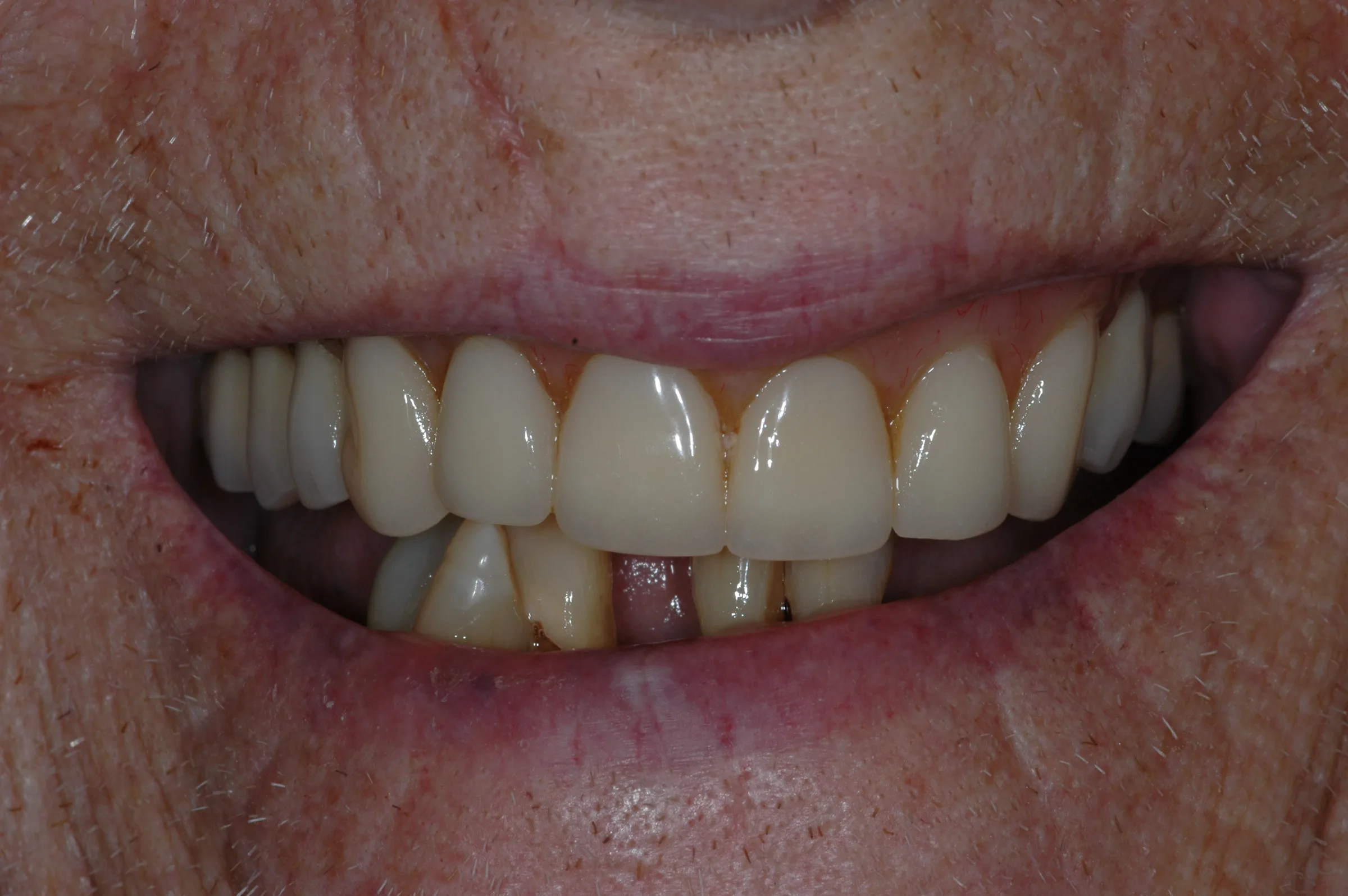 Before — All-on-4 / Full Arch