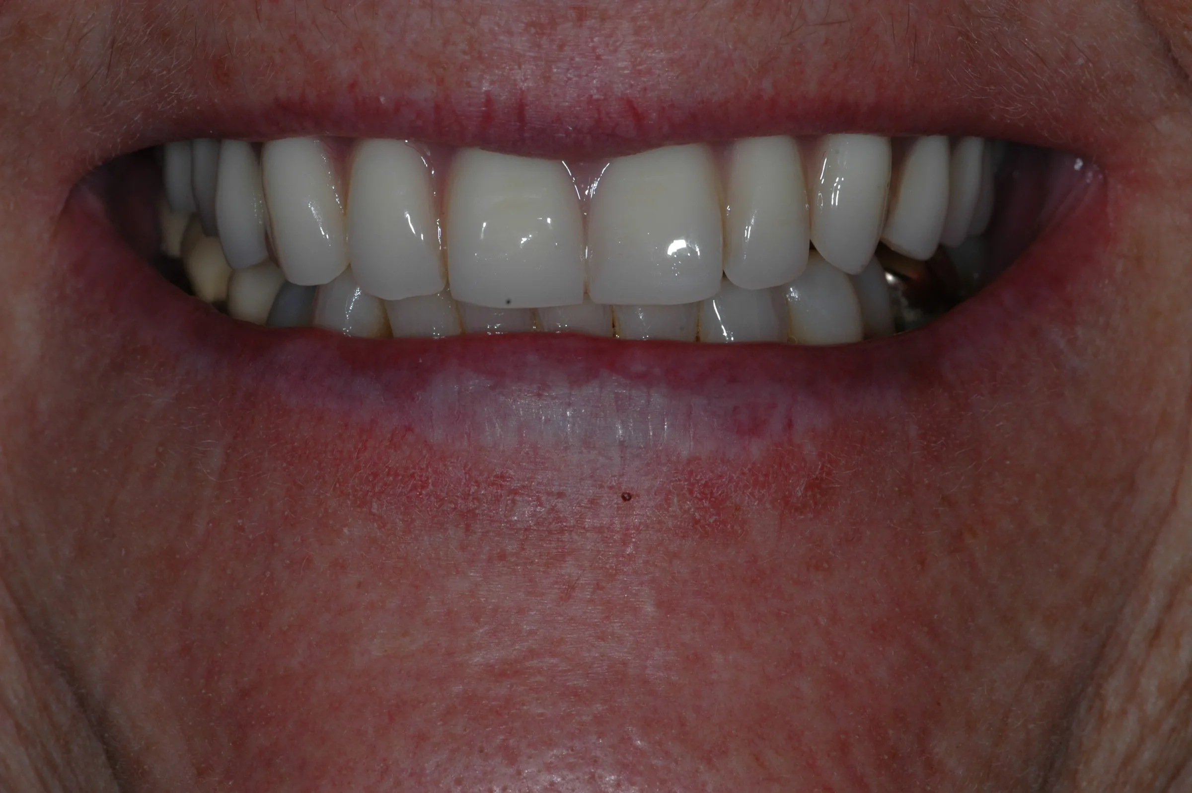 After — Dentures