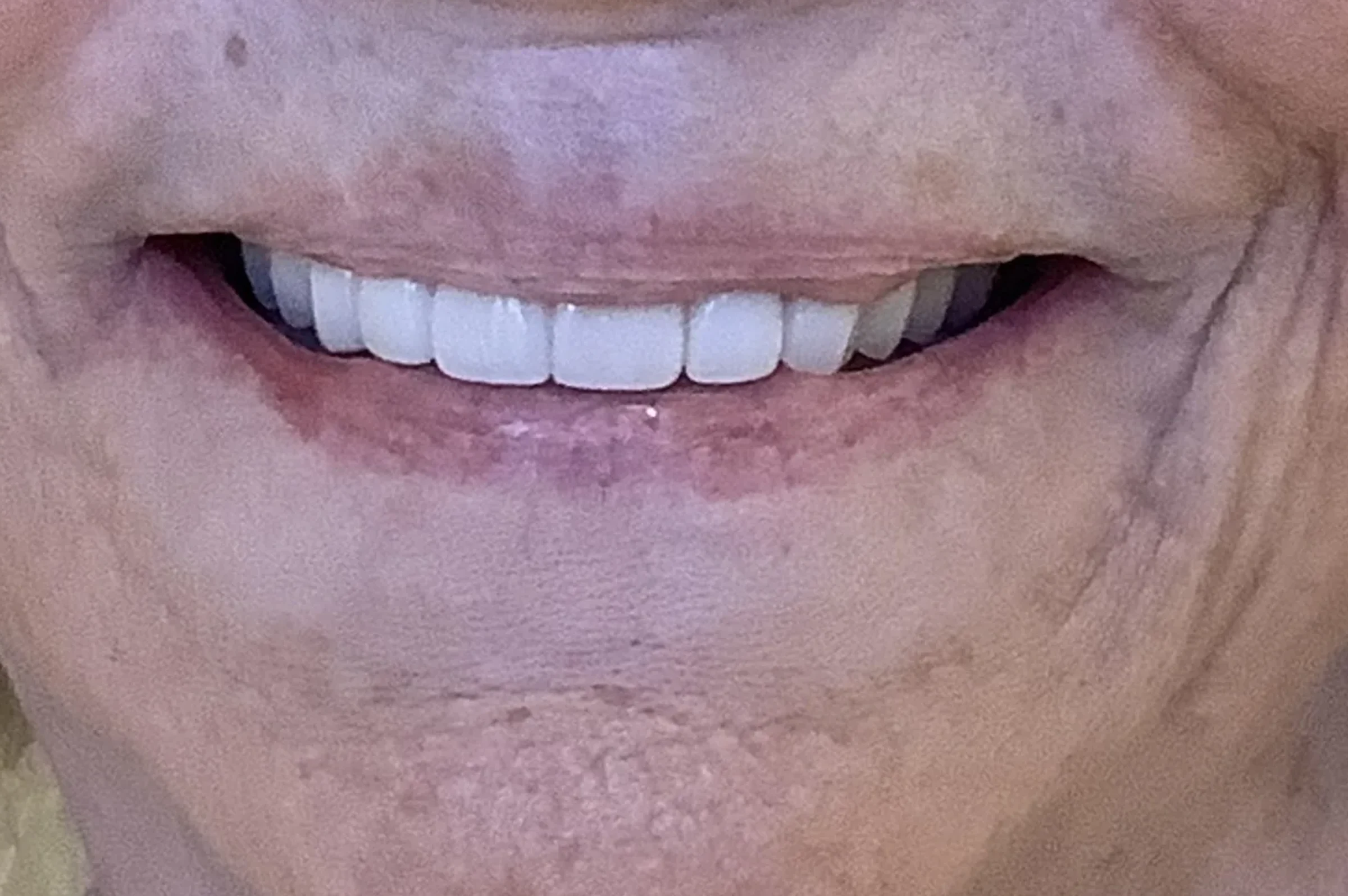 After — Smile Makeover (multiple procedures)