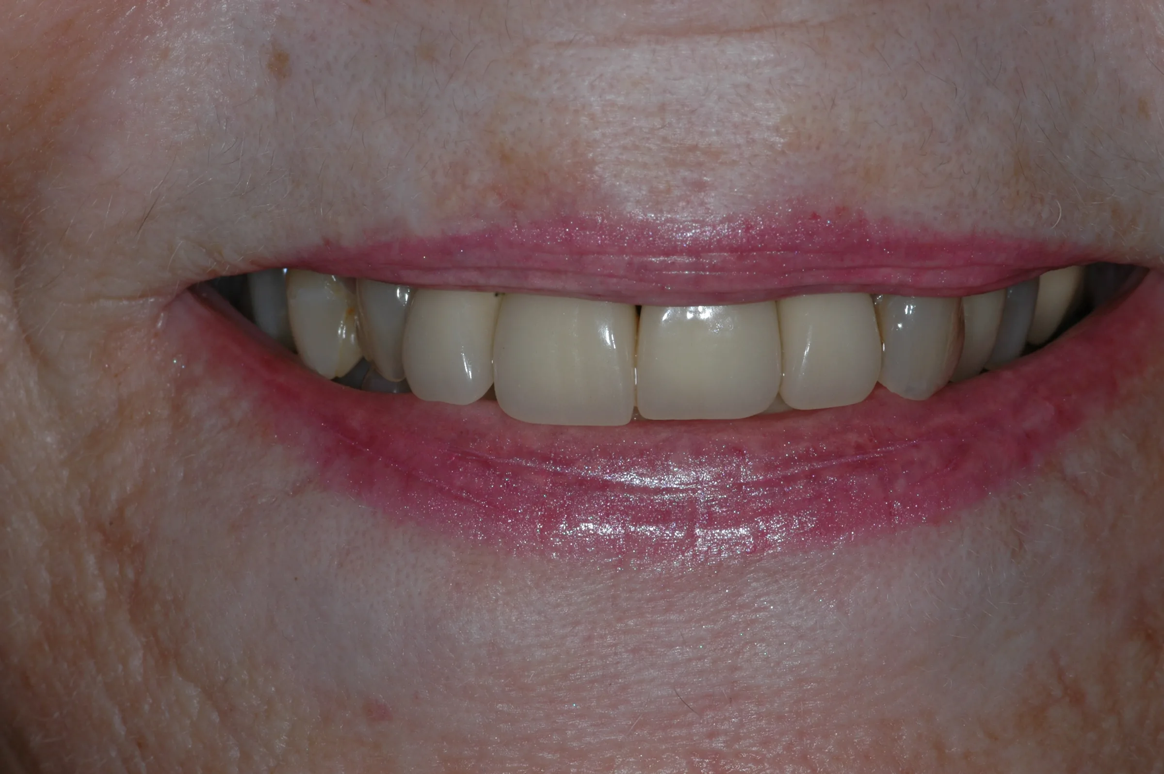 Before — Smile Makeover (multiple procedures)