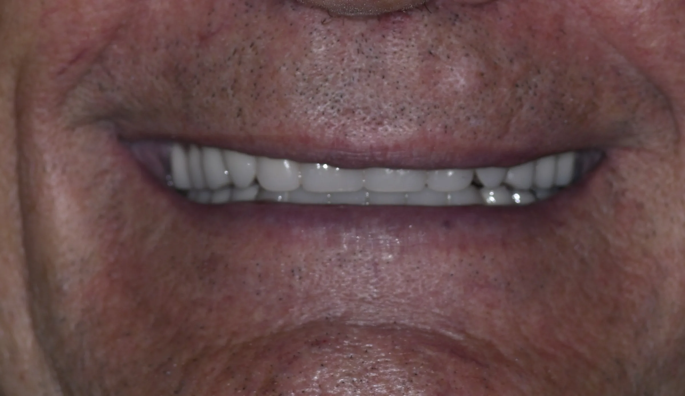 After — Dentures