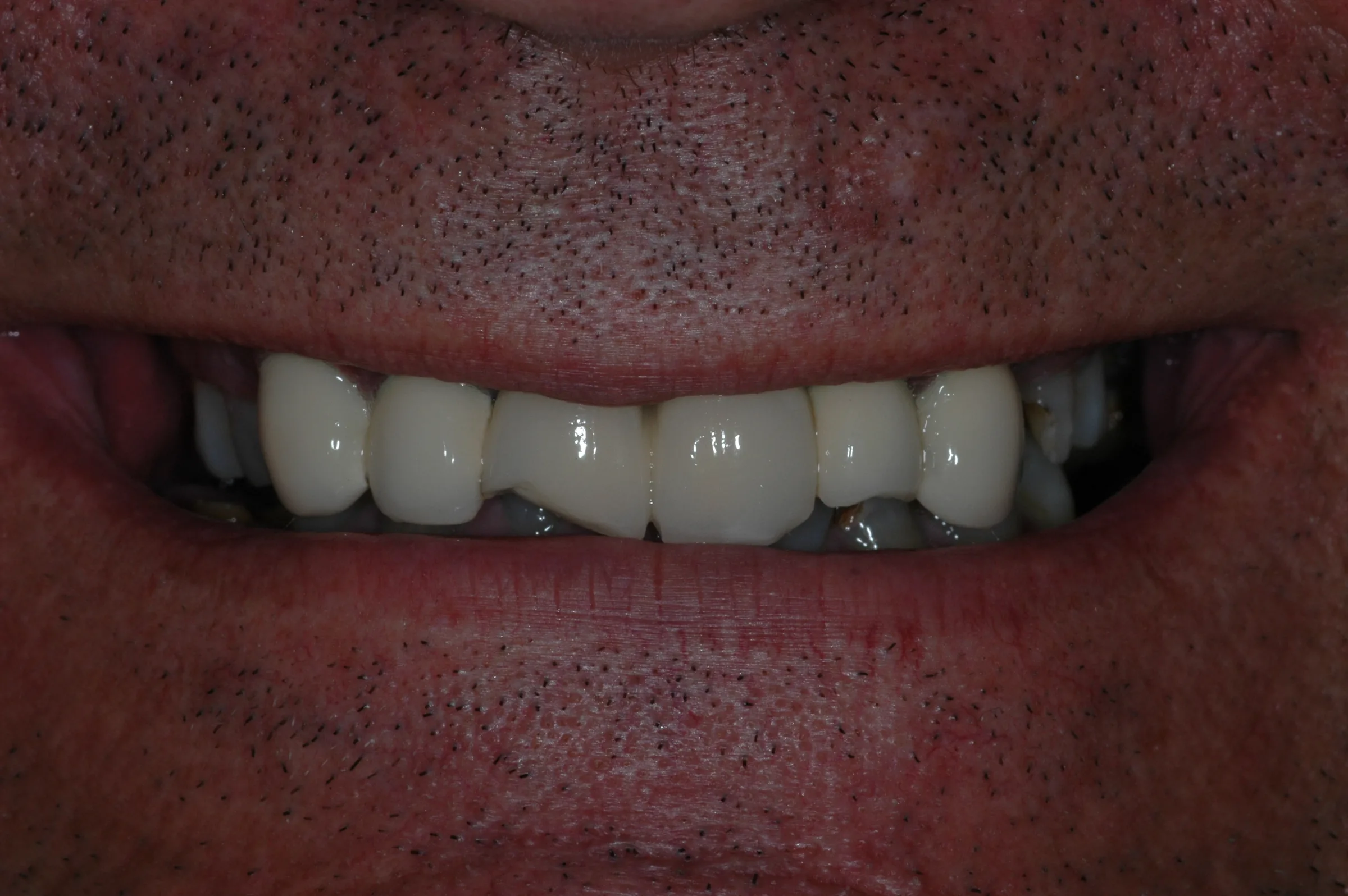 Before — Dentures