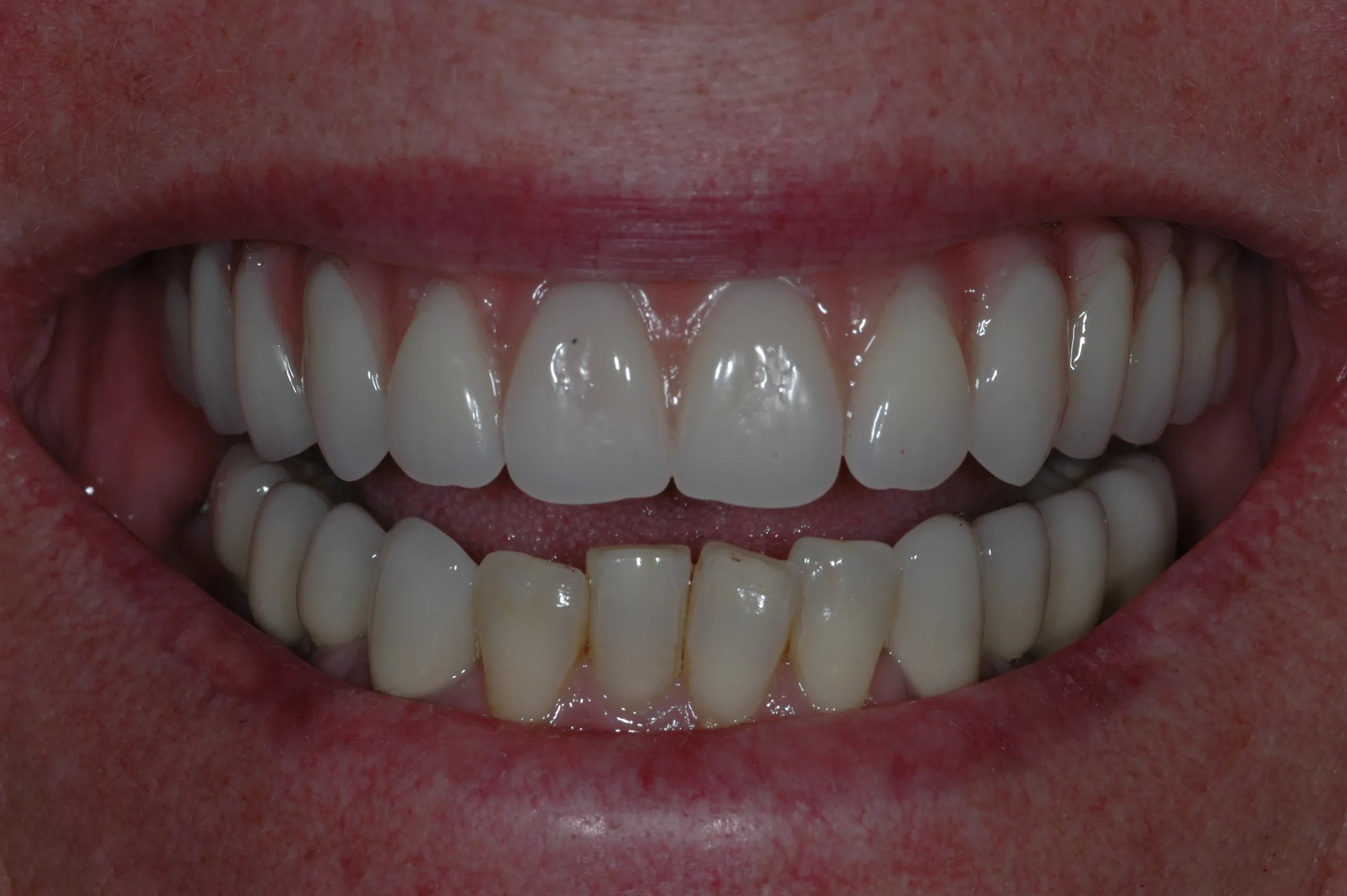 After — Dental Implants