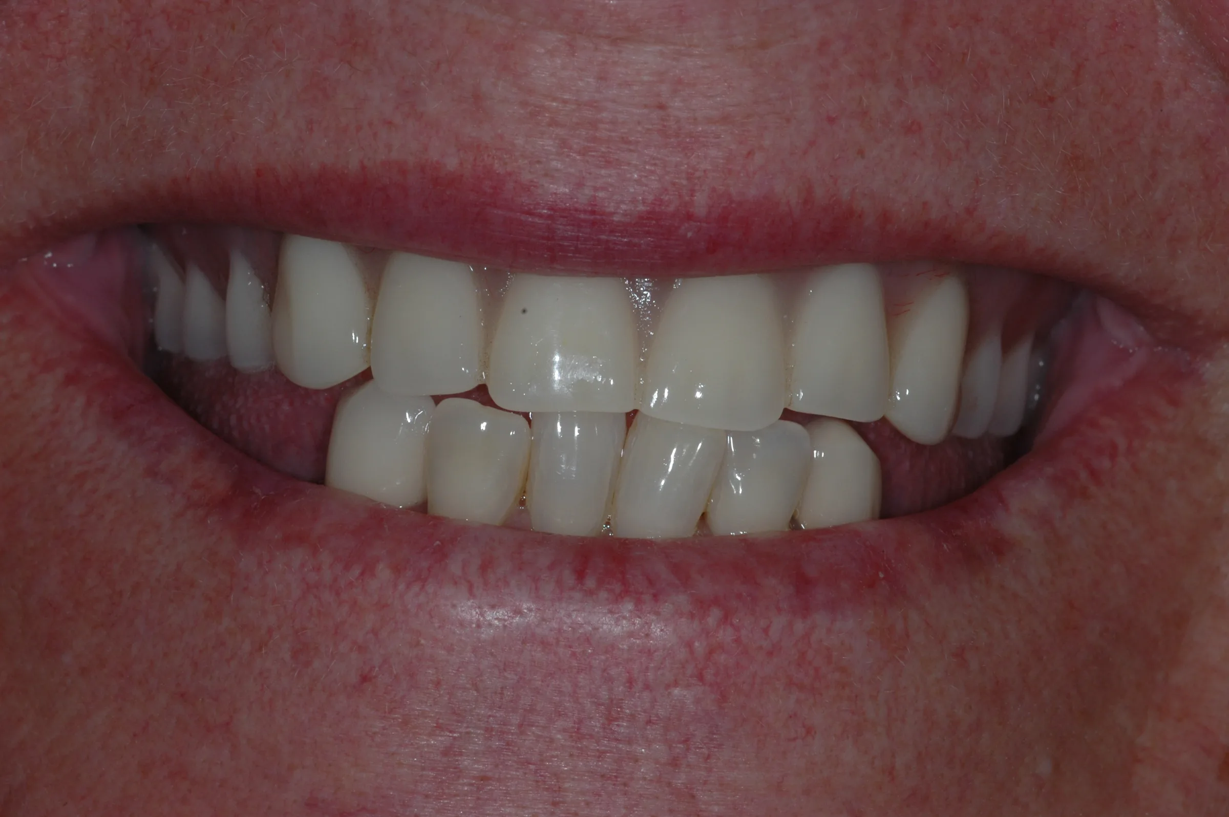 Before — Dental Implants
