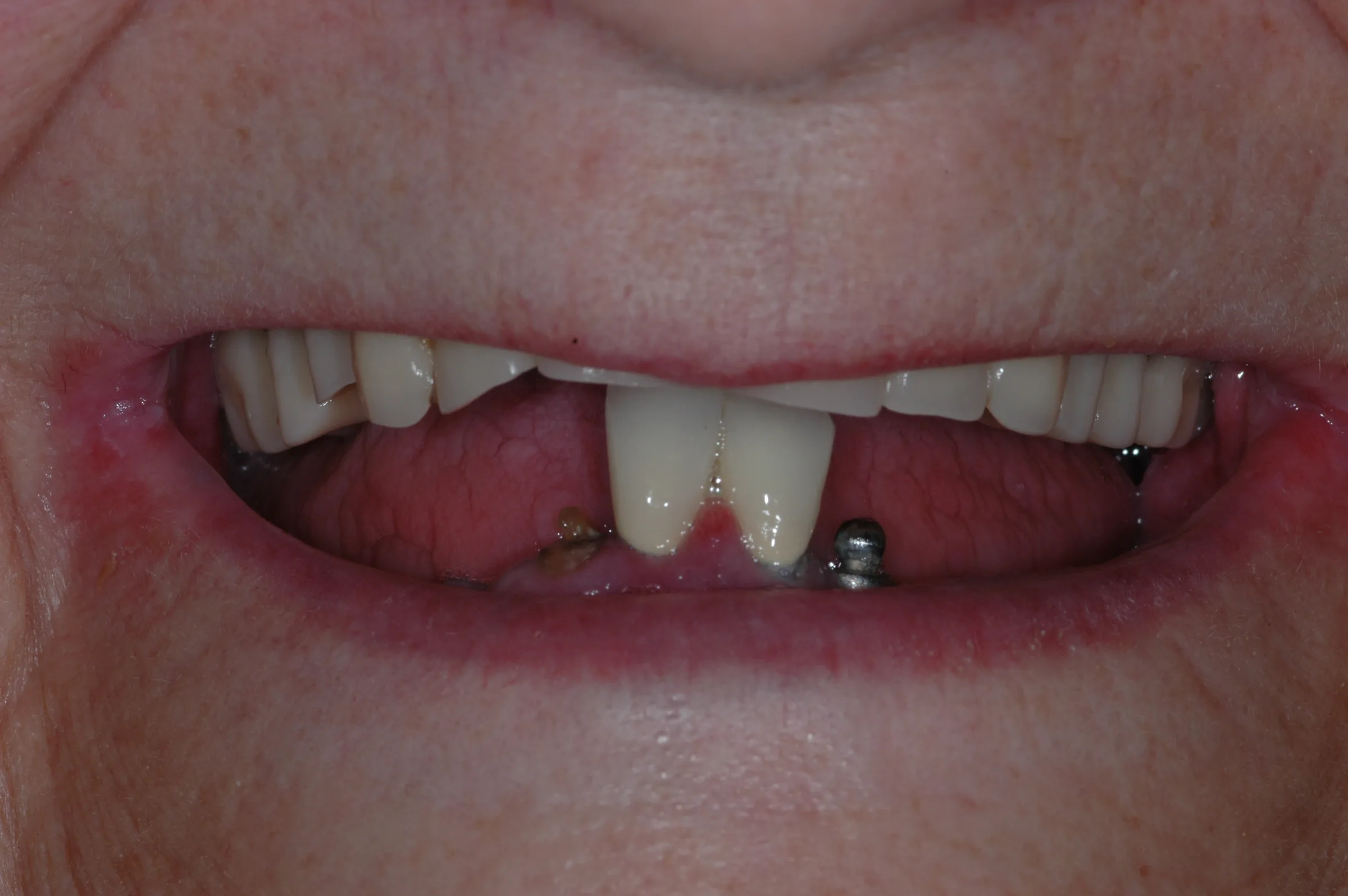 Before — All-on-4 / Full Arch