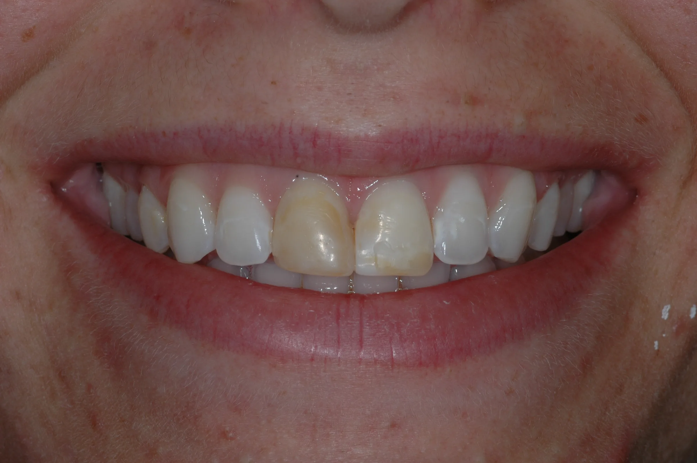 Before — Cosmetic Crowns